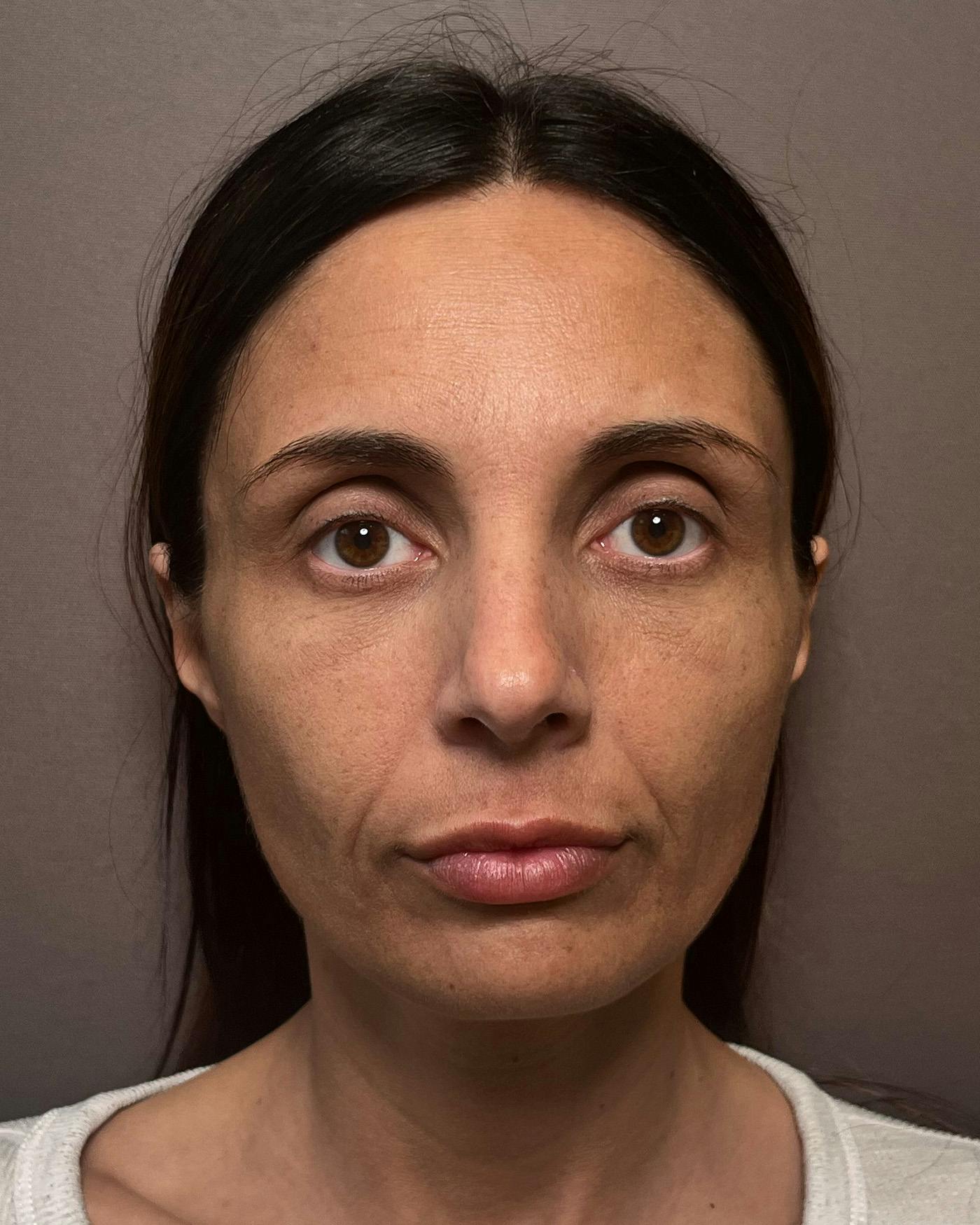 Facelifts / Necklift Before & After Gallery - Patient 400757 - Image 5