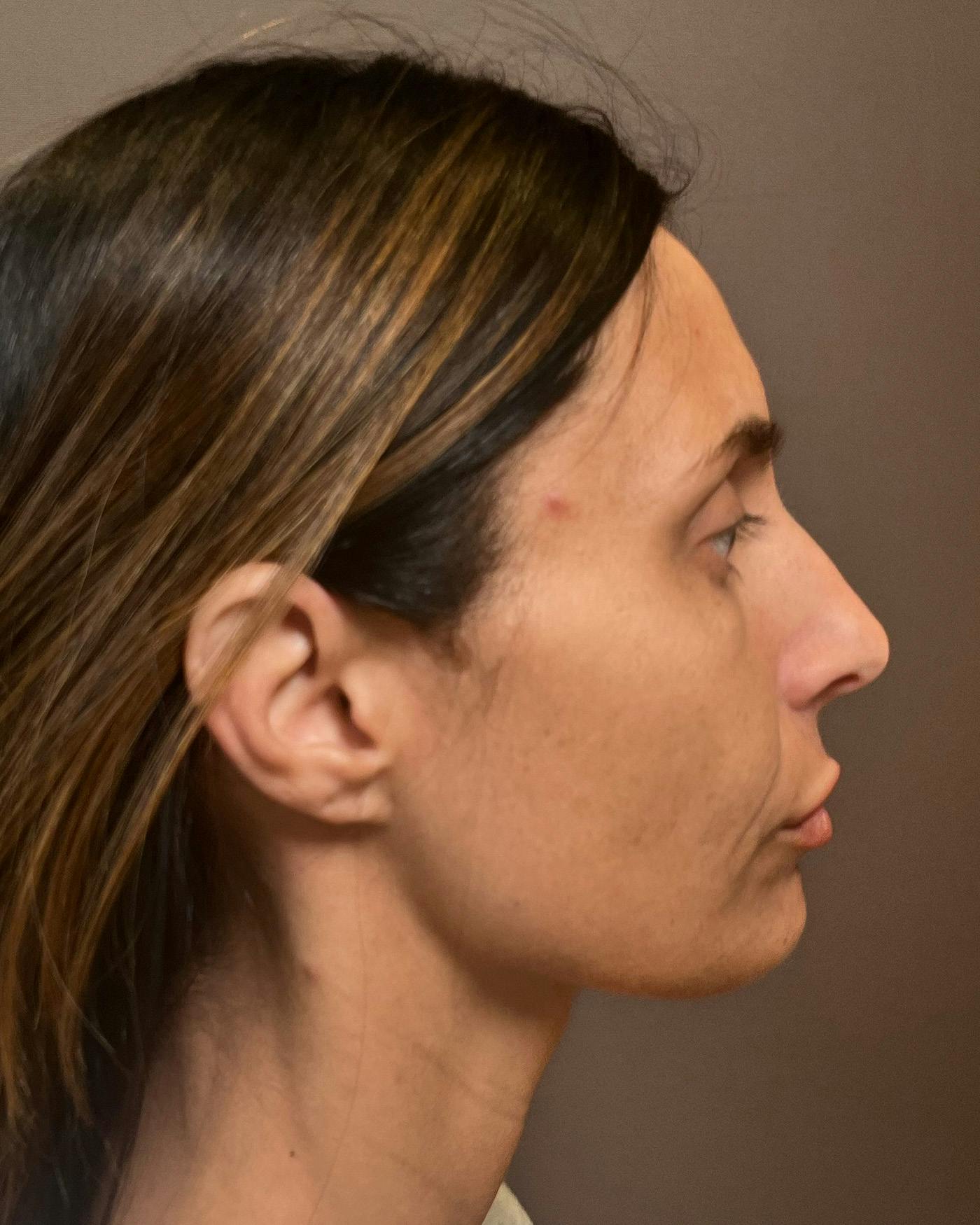 Facelifts / Necklift Before & After Gallery - Patient 400757 - Image 3