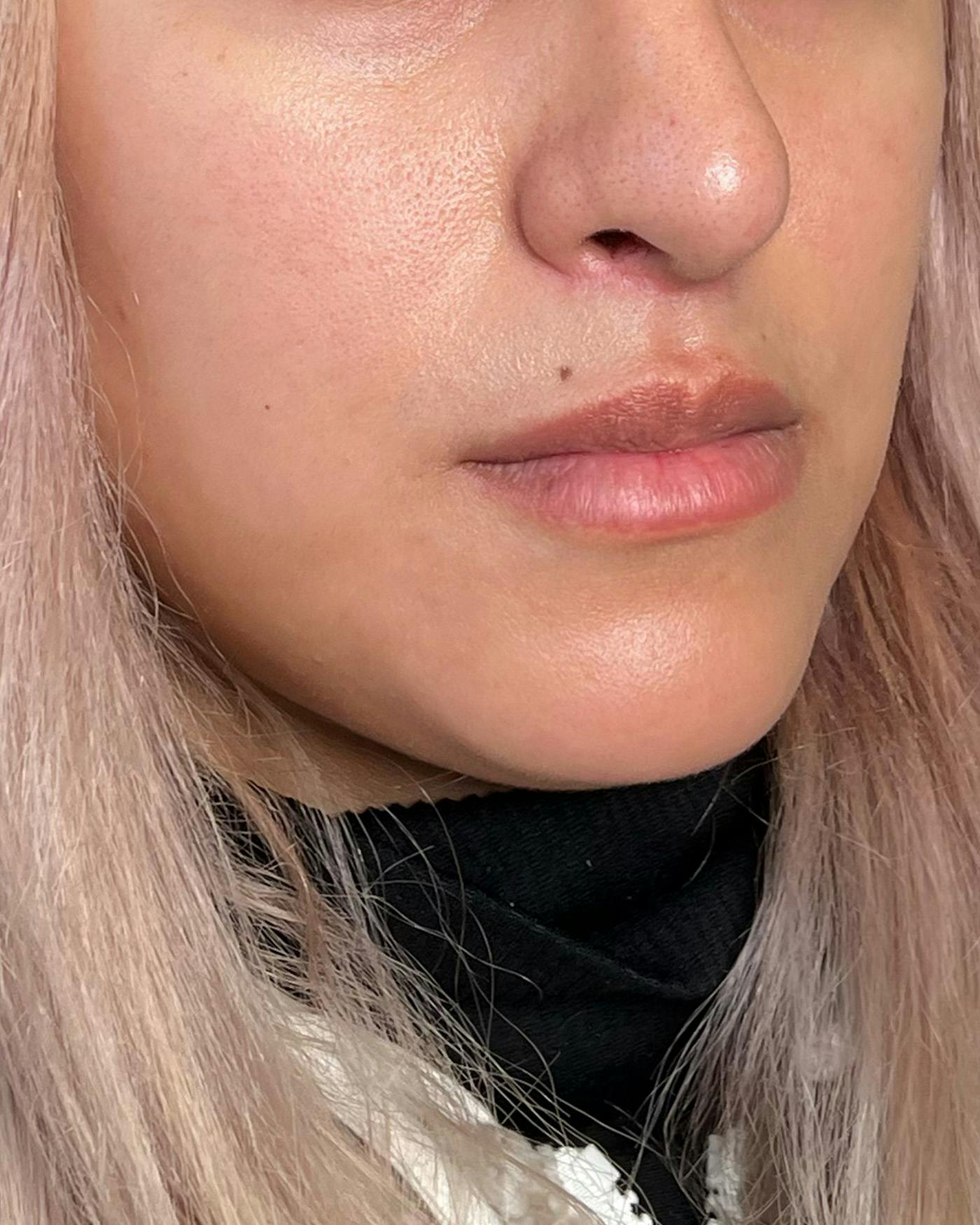 Lip Lift / Lip Reduction Before & After Gallery - Patient 310400 - Image 4