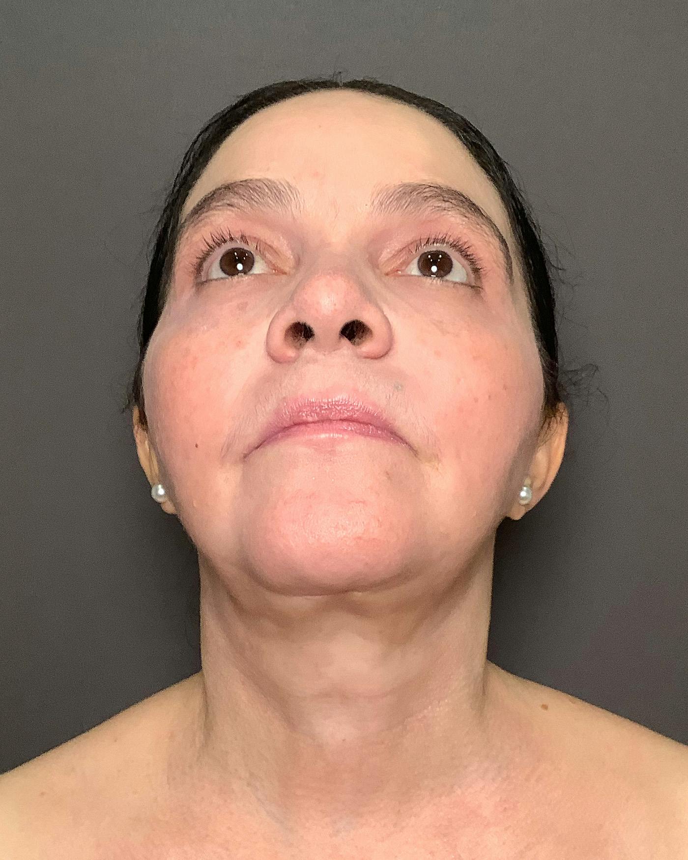 Facelifts / Necklift Before & After Gallery - Patient 754198 - Image 6