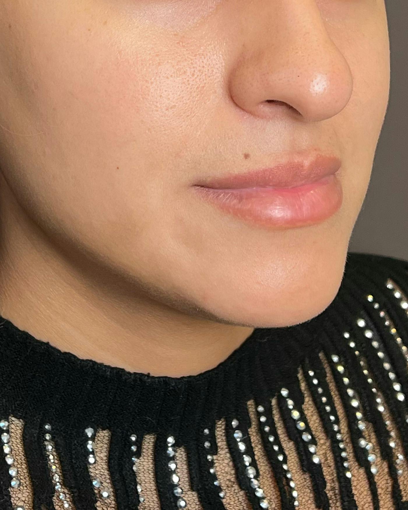 Lip Lift / Lip Reduction Before & After Gallery - Patient 310400 - Image 3