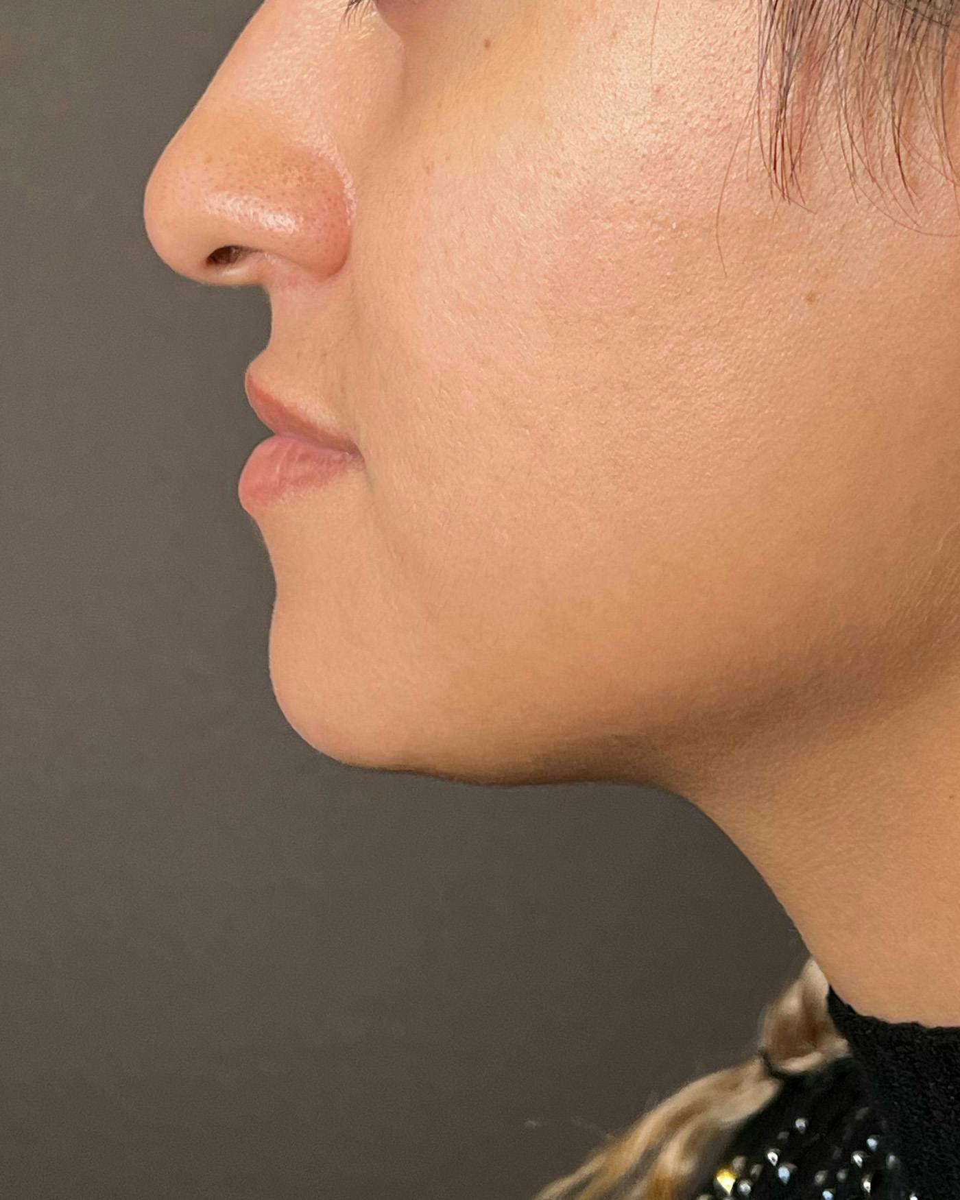 Lip Lift / Lip Reduction Before & After Gallery - Patient 310400 - Image 7