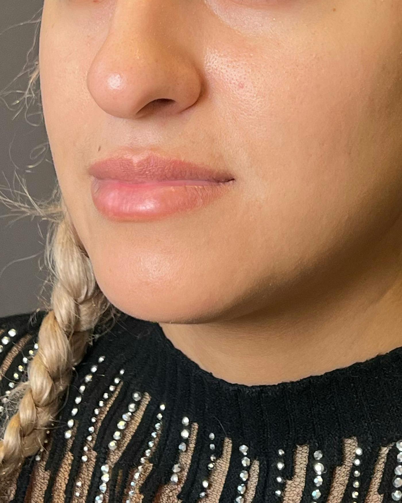 Lip Lift / Lip Reduction Before & After Gallery - Patient 310400 - Image 5