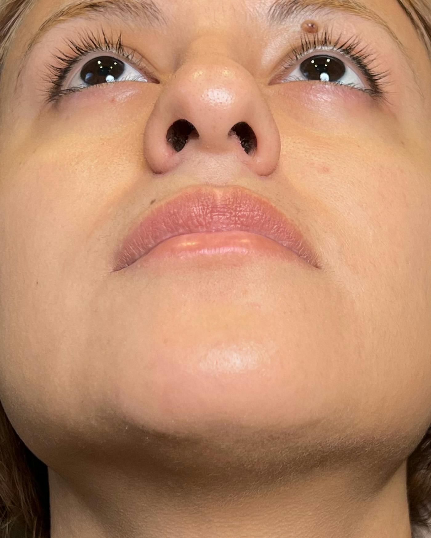 Lip Lift / Lip Reduction Before & After Gallery - Patient 310400 - Image 9
