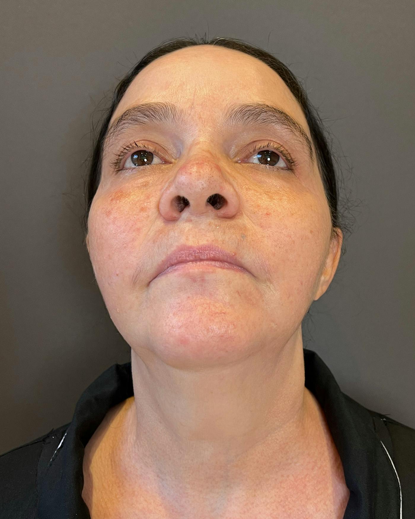 Facelifts / Necklift Before & After Gallery - Patient 754198 - Image 5