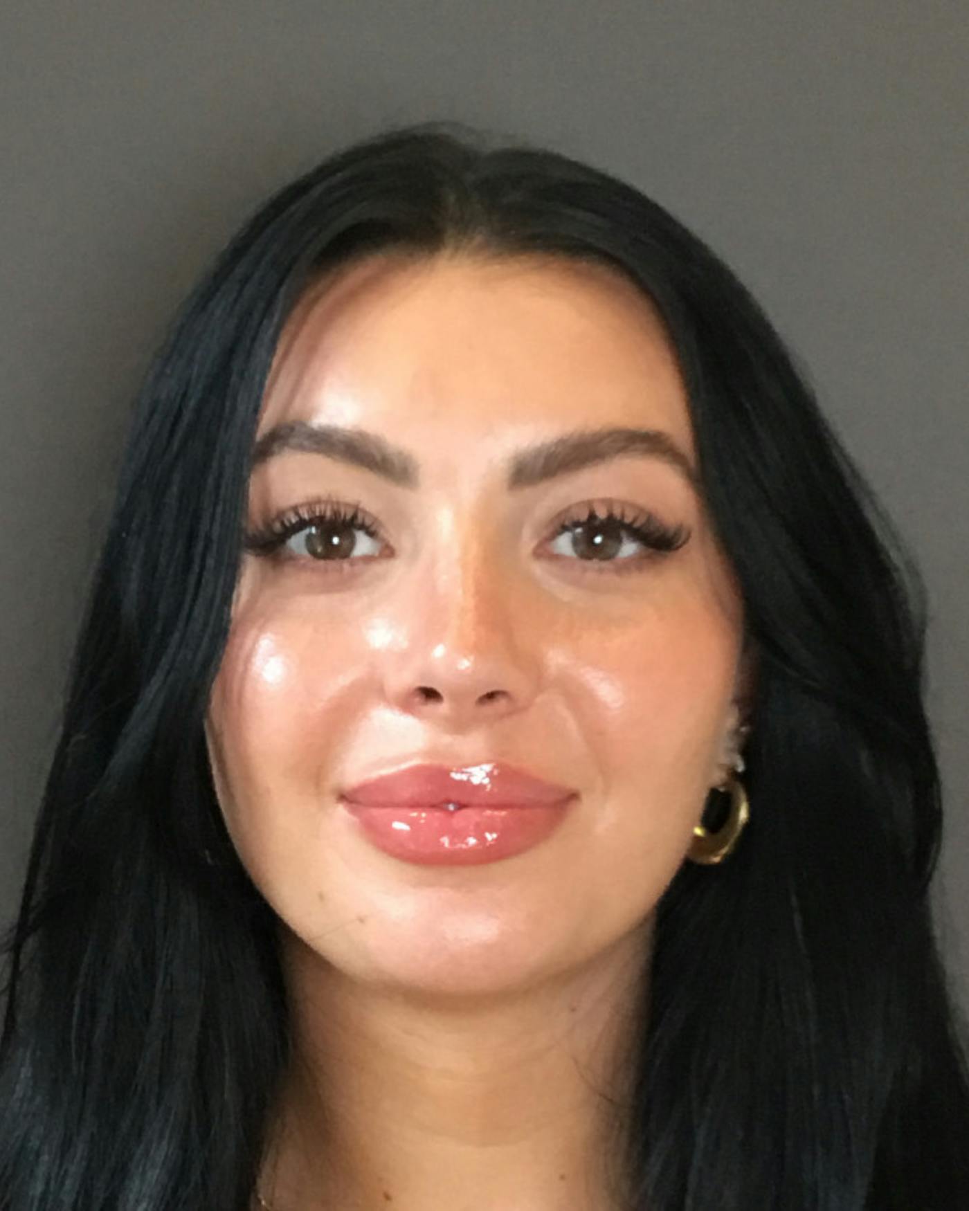 Rhinoplasty Before & After Gallery - Patient 390758 - Image 6