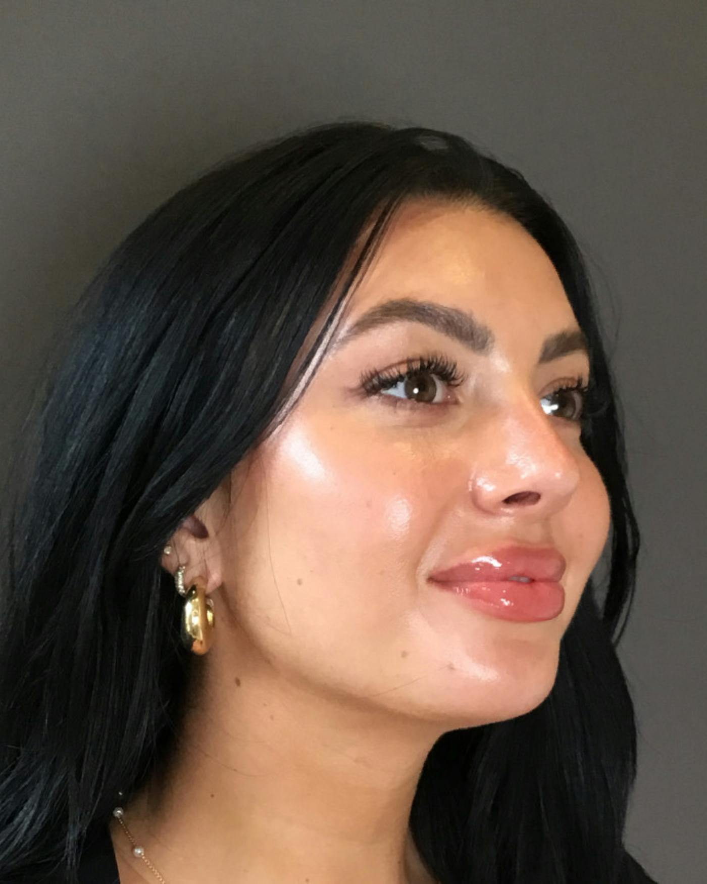 Rhinoplasty Before & After Gallery - Patient 390758 - Image 4