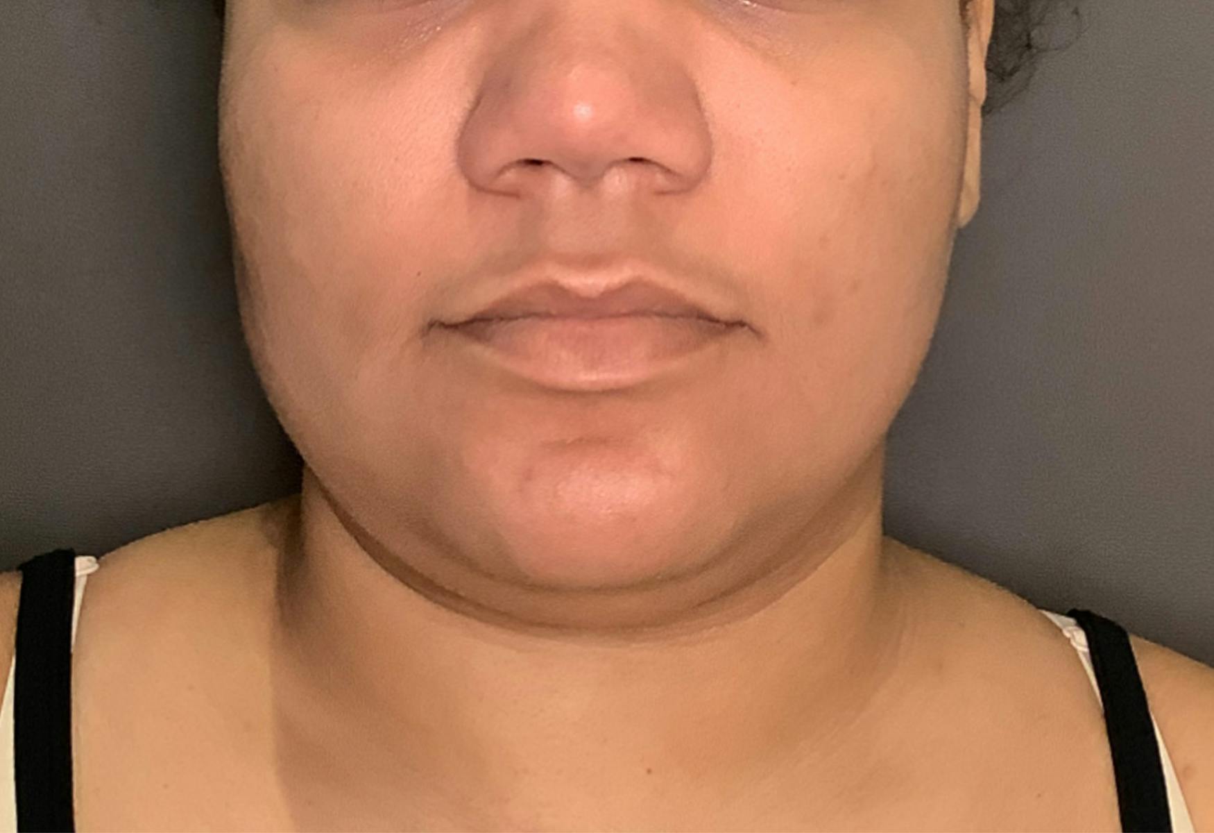 Liposuction Before & After Gallery - Patient 175992 - Image 1