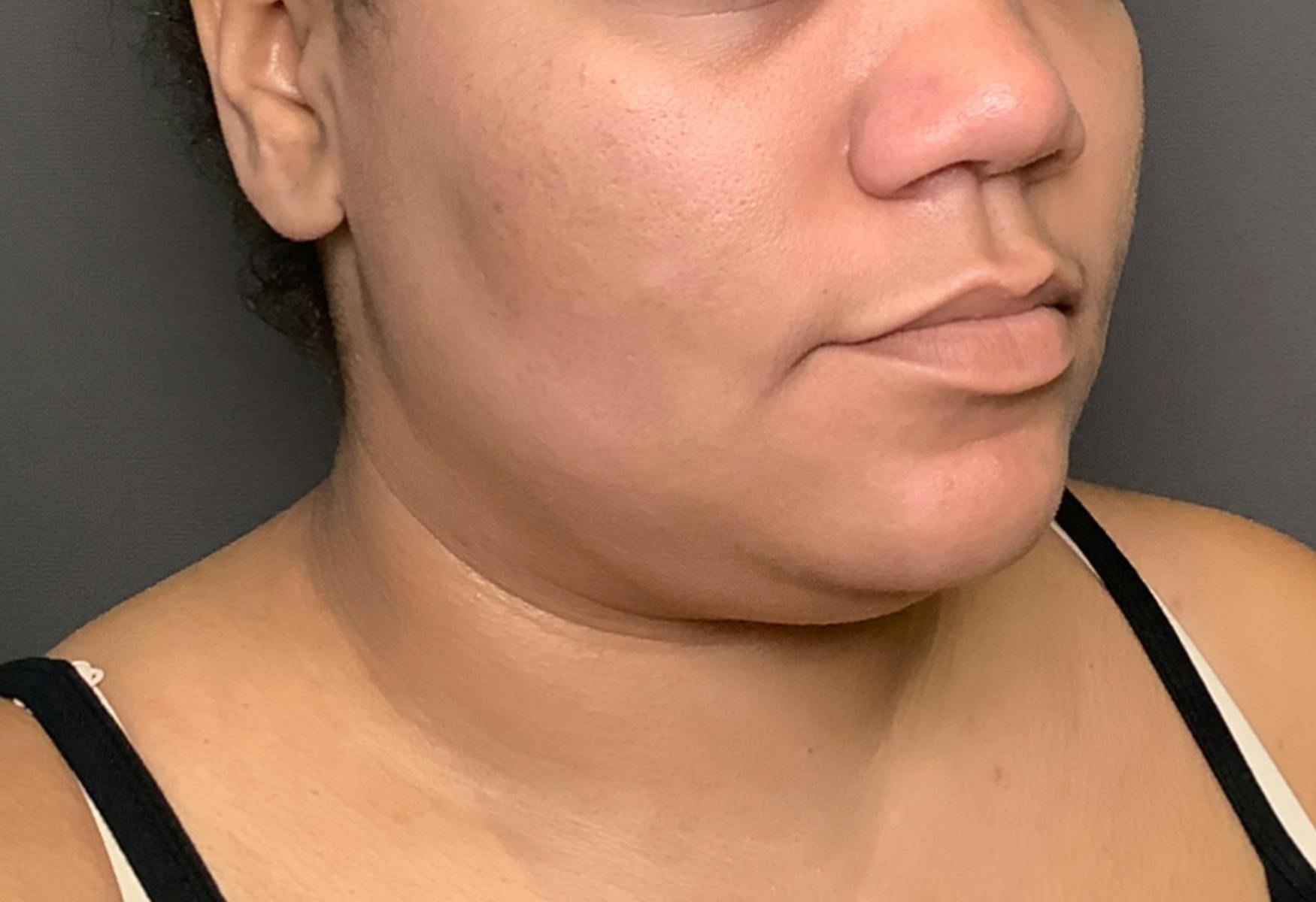 Liposuction Before & After Gallery - Patient 175992 - Image 3