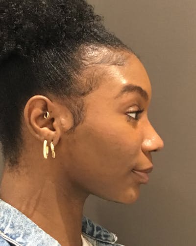 Rhinoplasty Before & After Gallery - Patient 297780 - Image 2