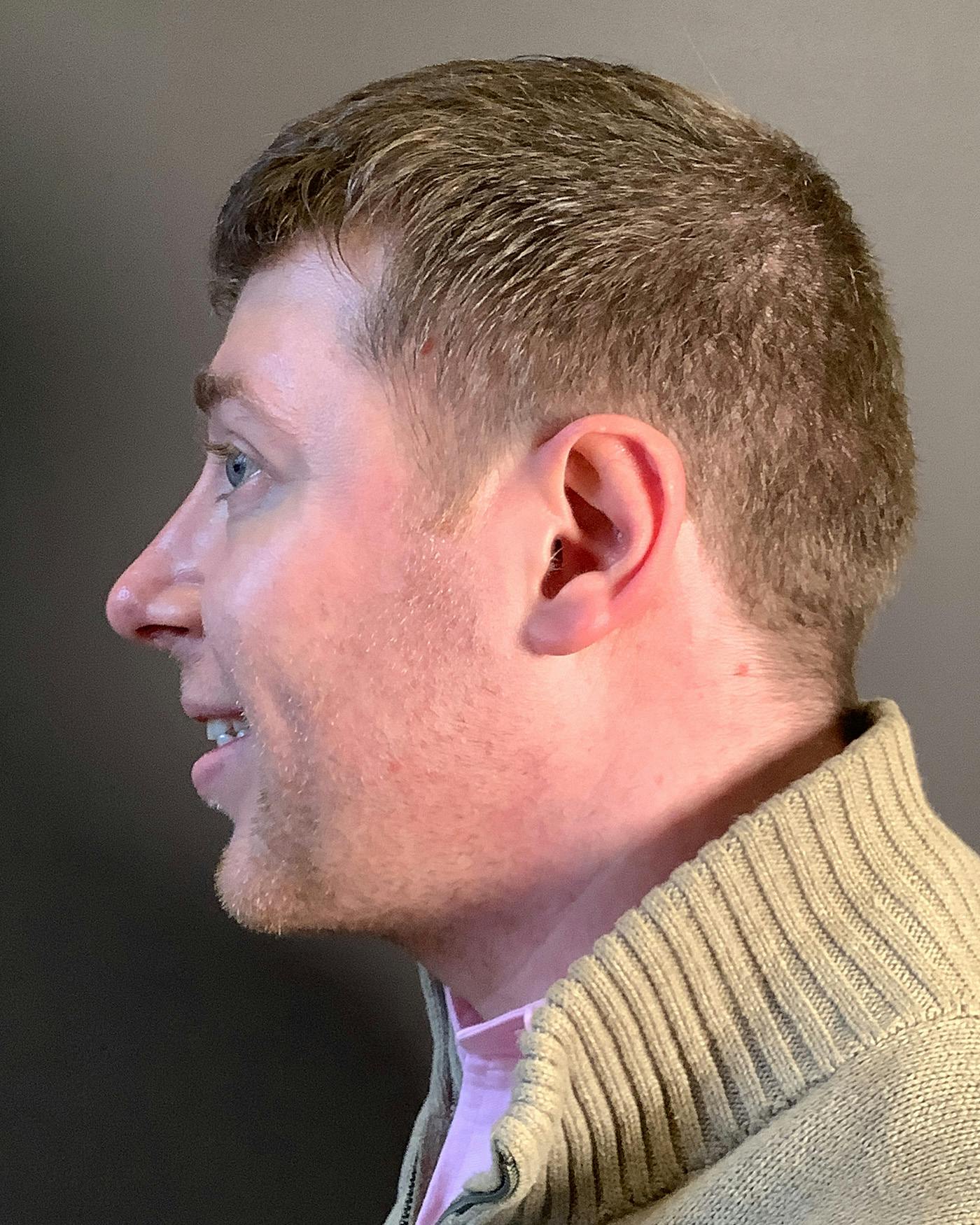Liposuction Before & After Gallery - Patient 145013 - Image 10