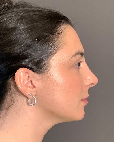 Rhinoplasty Before & After Gallery - Patient 398006 - Image 2