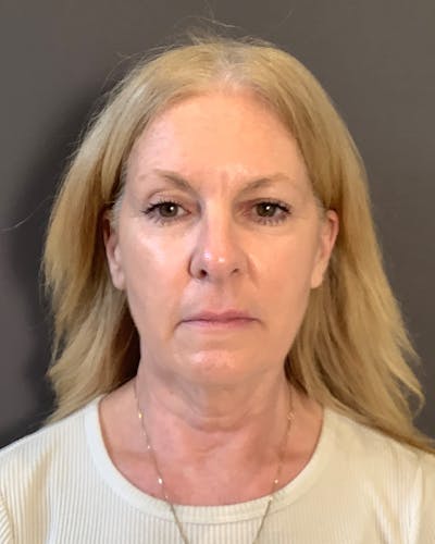 Eyelid Surgery Before & After Gallery - Patient 358267 - Image 1