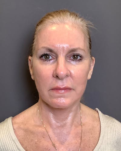 Eyelid Surgery Before & After Gallery - Patient 358267 - Image 2