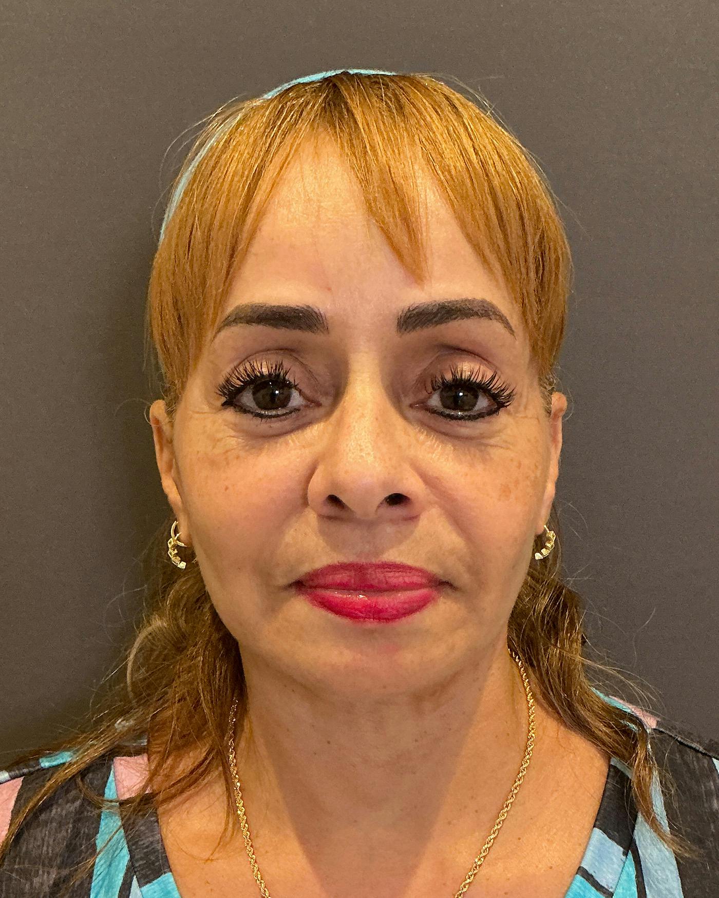 Facelifts / Necklift Before & After Gallery - Patient 111271 - Image 6