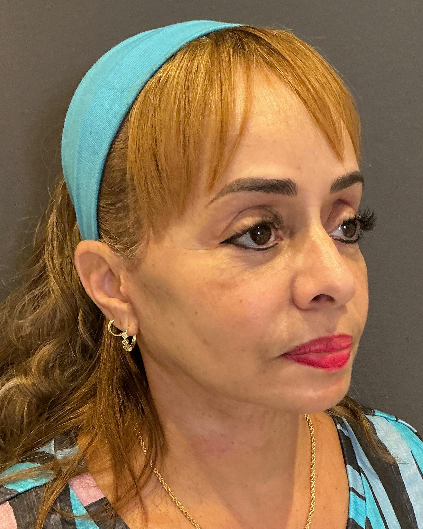 Facelifts / Necklift Before & After Gallery - Patient 111271 - Image 2