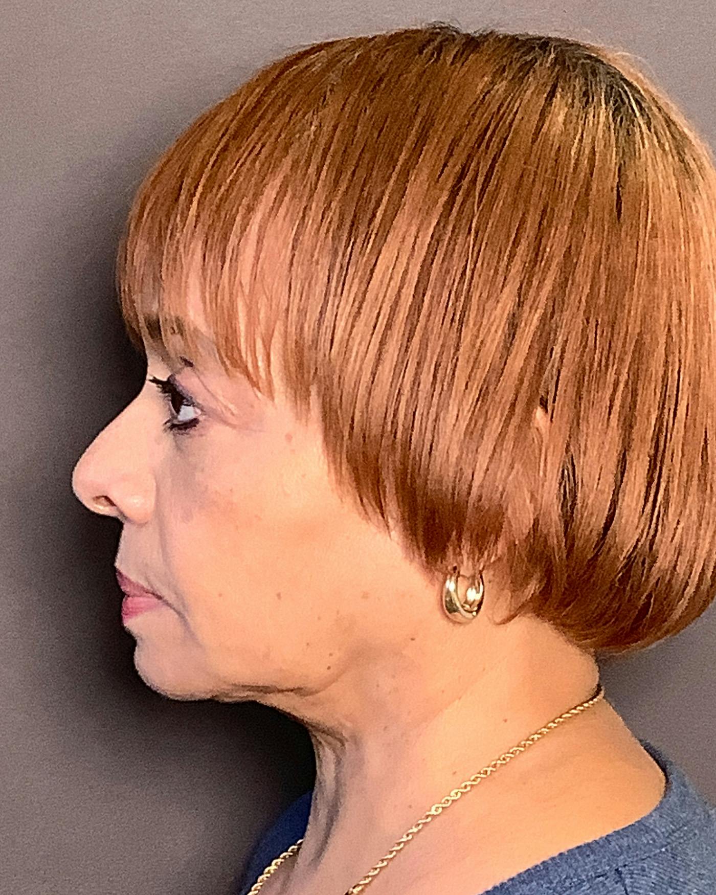 Facelifts / Necklift Before & After Gallery - Patient 111271 - Image 9