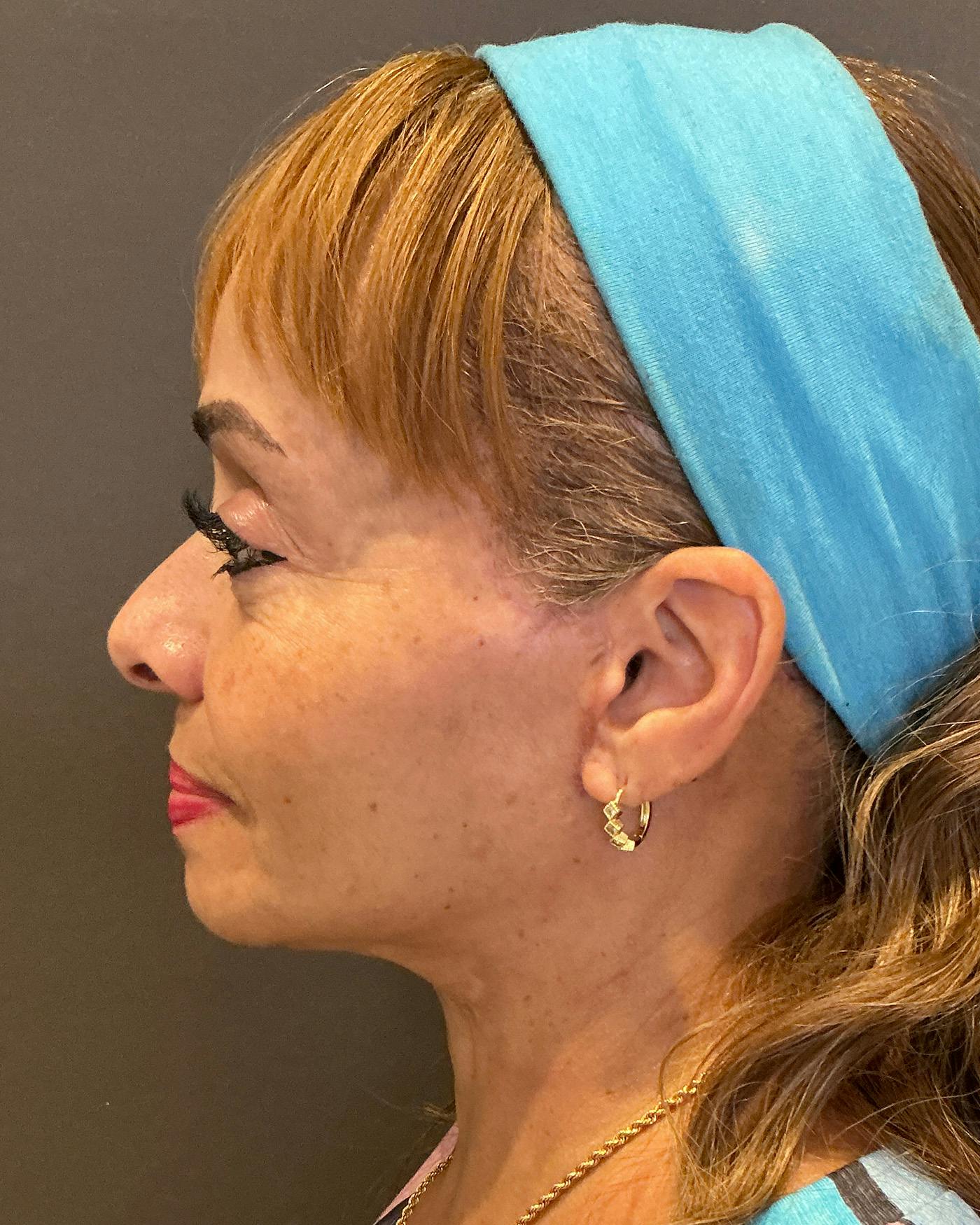Facelifts / Necklift Before & After Gallery - Patient 111271 - Image 10