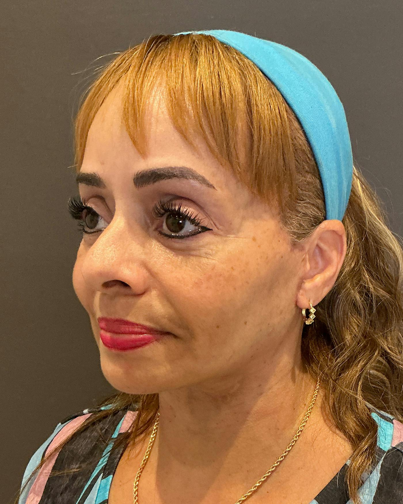 Facelifts / Necklift Before & After Gallery - Patient 111271 - Image 8