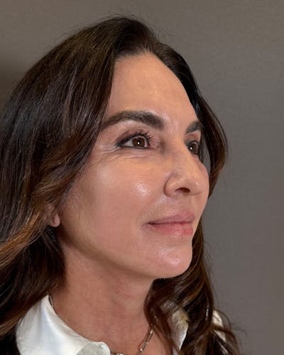 Facelifts / Necklift Before & After Gallery - Patient 283733 - Image 2