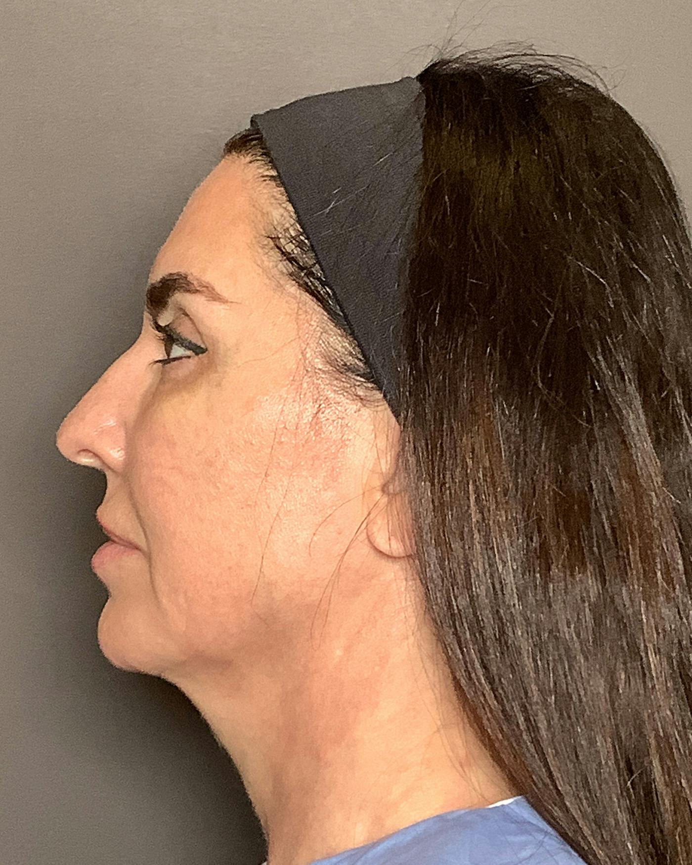 CO2 Full Face Before & After Gallery - Patient 458833 - Image 9