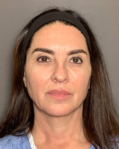 Facial Fat Transfer Before & After Gallery - Patient 250454 - Image 1