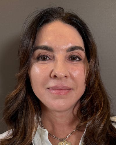 Facial Fat Transfer Before & After Gallery - Patient 250454 - Image 2