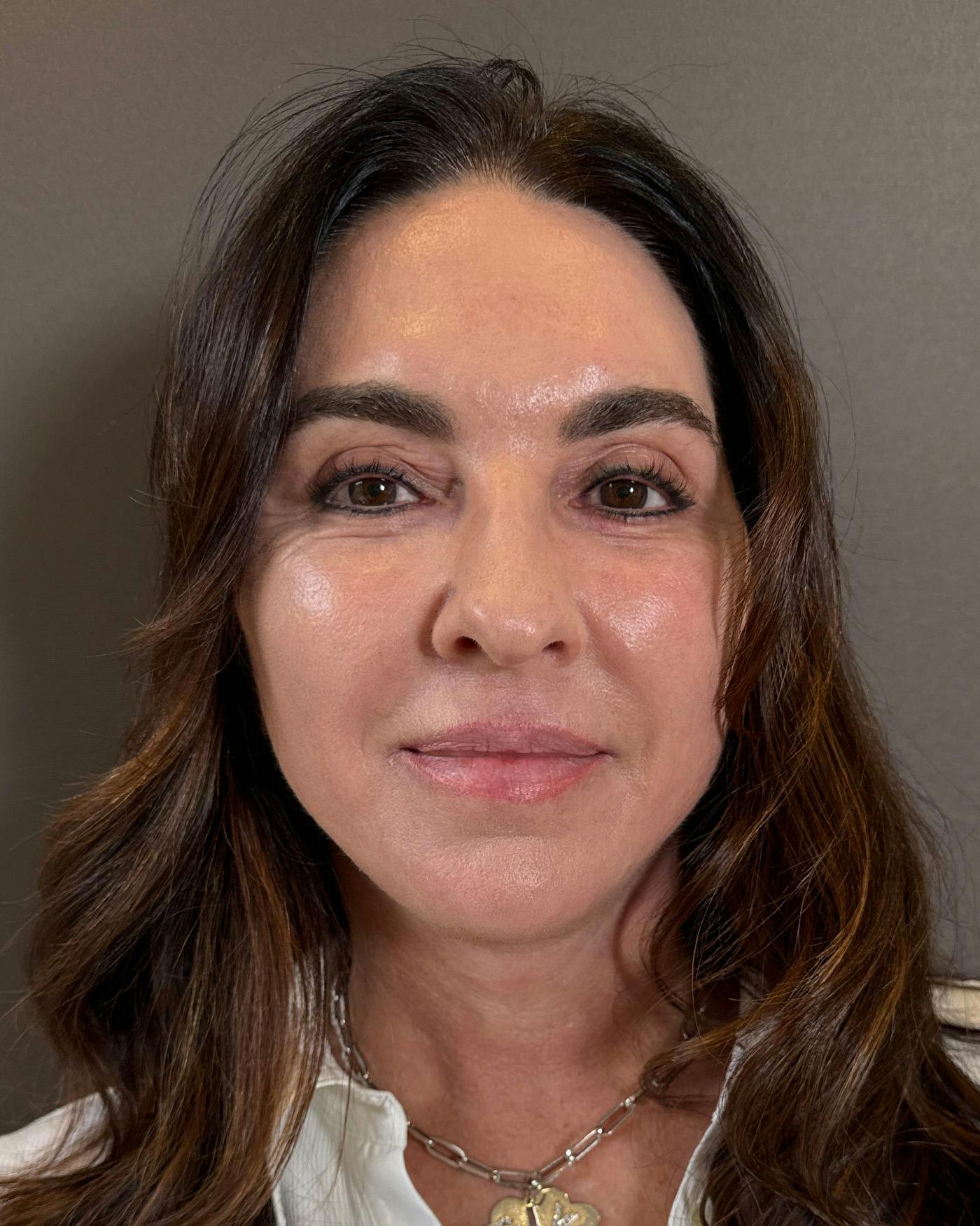 CO2 Full Face Before & After Gallery - Patient 458833 - Image 2