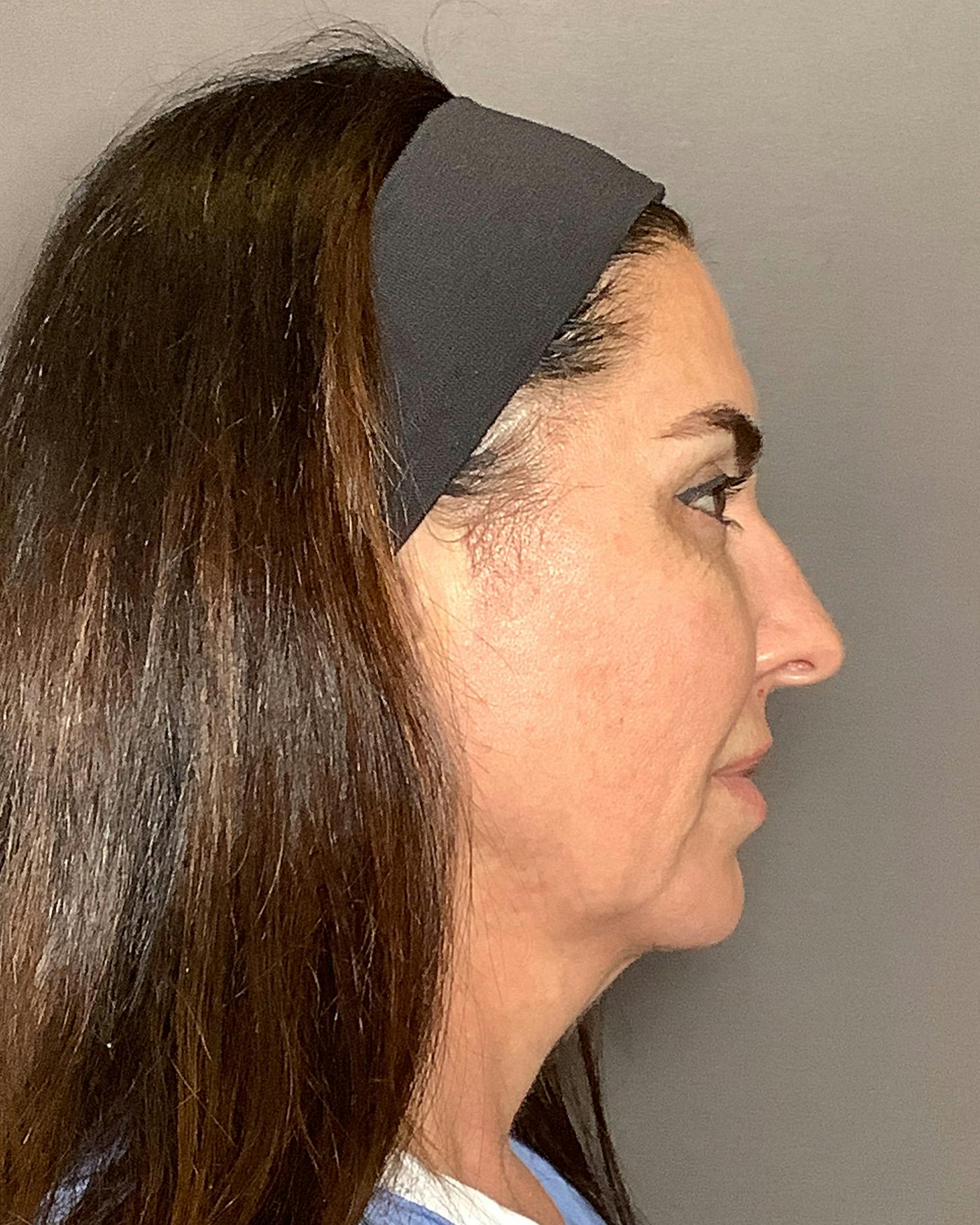 CO2 Full Face Before & After Gallery - Patient 458833 - Image 5