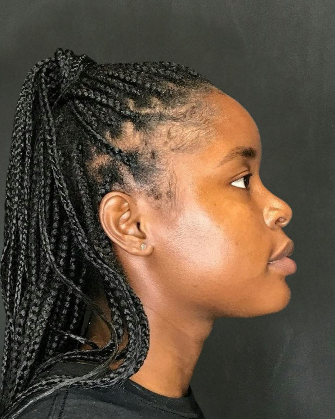 Rhinoplasty Before & After Gallery - Patient 151510787 - Image 1