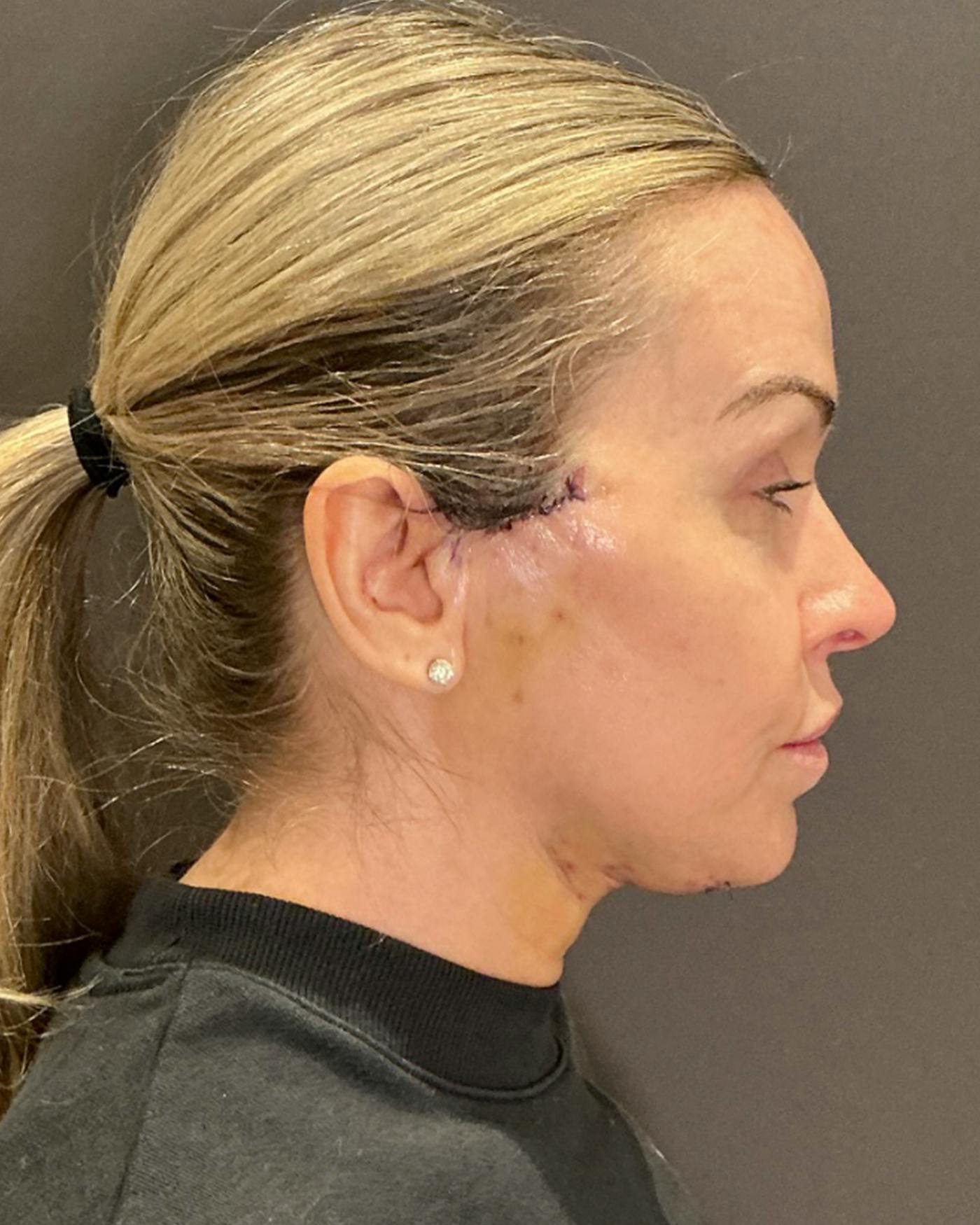 Nanolift Before & After Gallery - Patient 428237 - Image 4