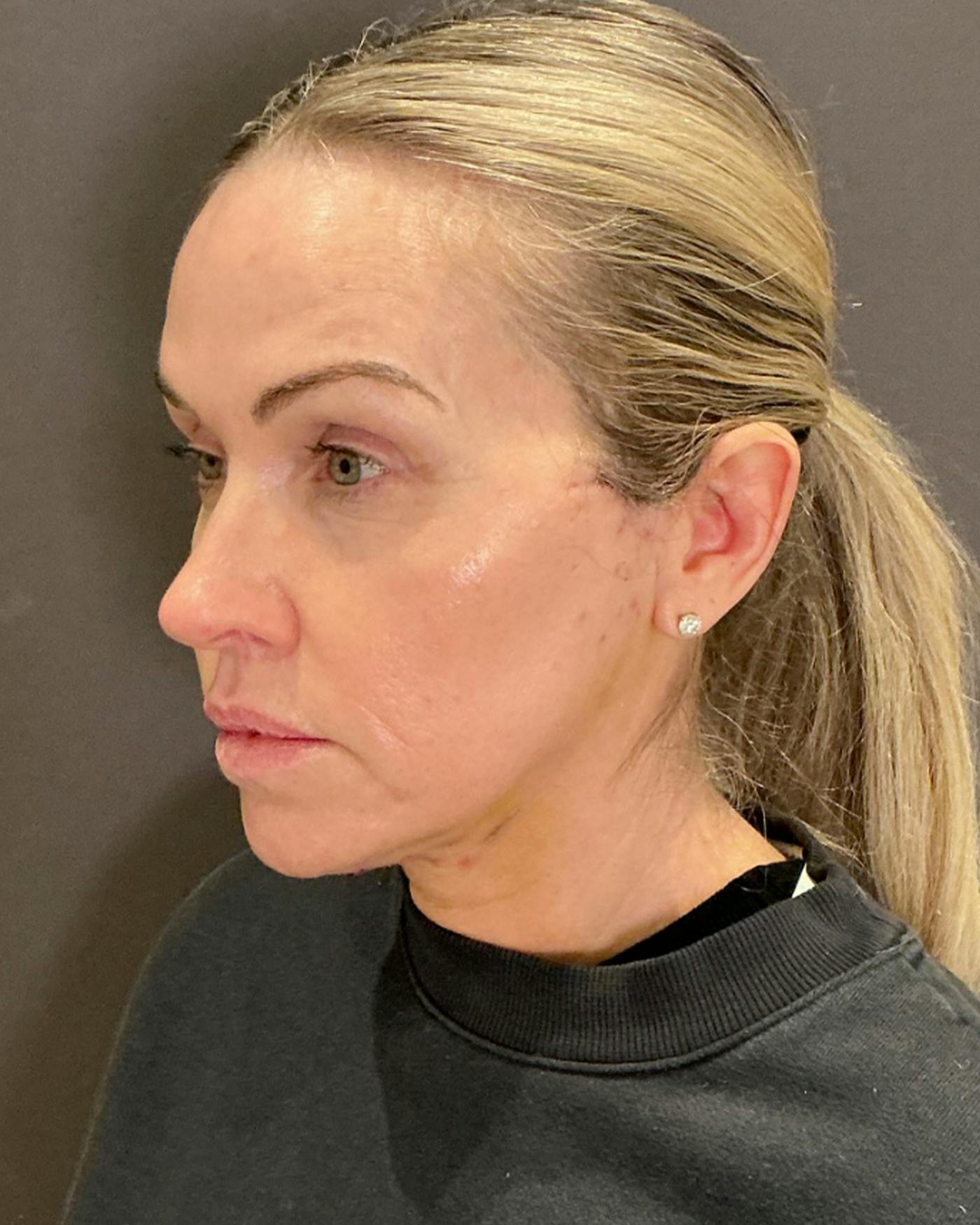 Nanolift Before & After Gallery - Patient 428237 - Image 8