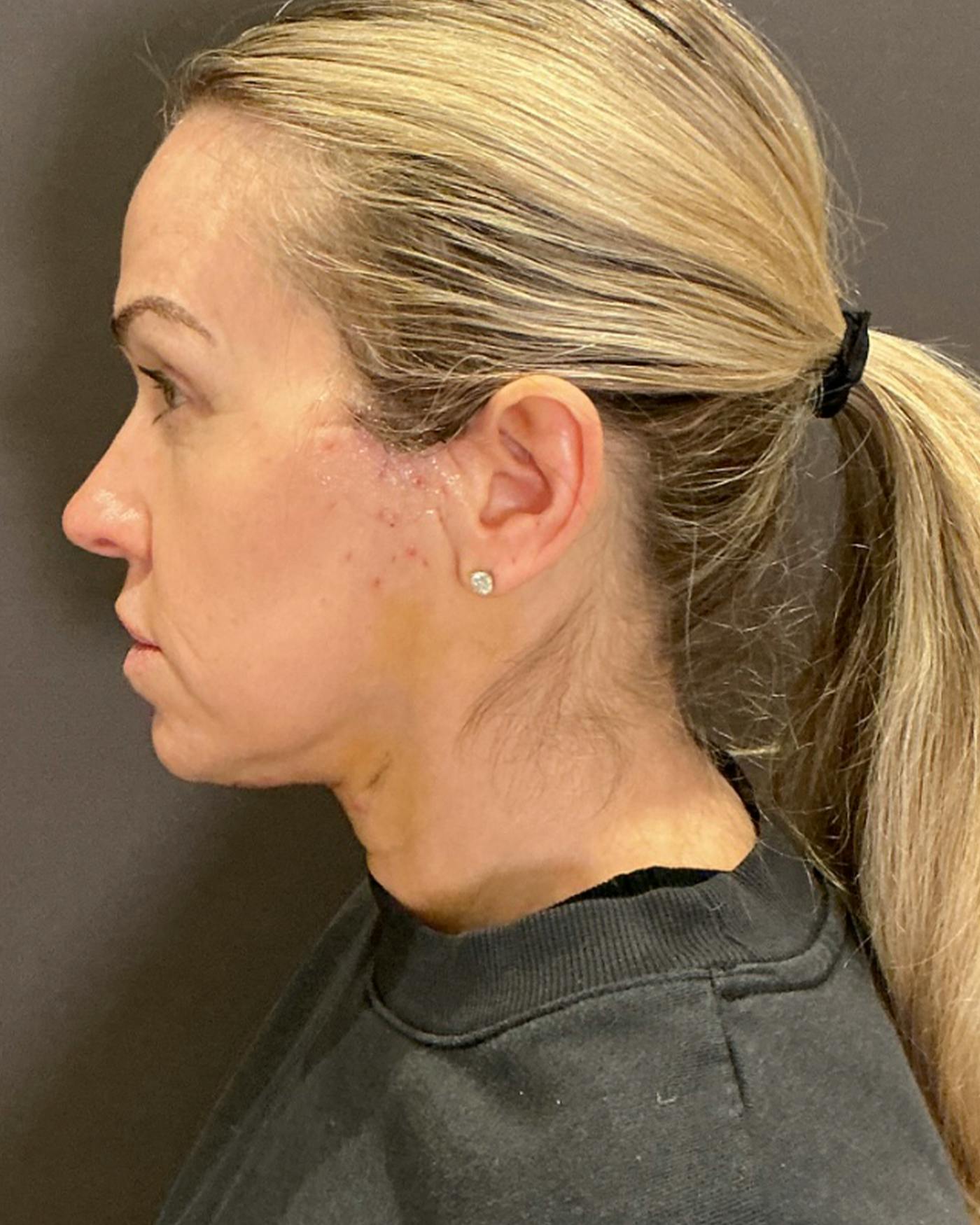 Nanolift Before & After Gallery - Patient 428237 - Image 10