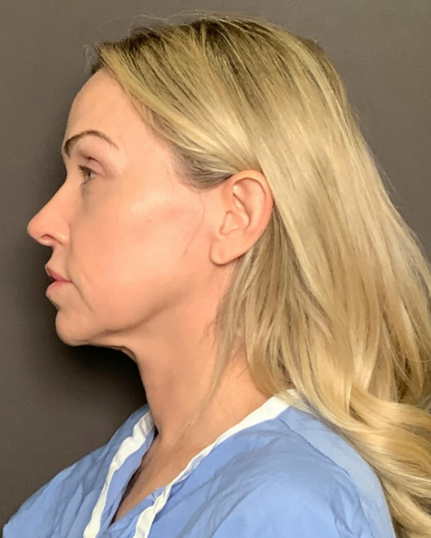 Nanolift Before & After Gallery - Patient 428237 - Image 9