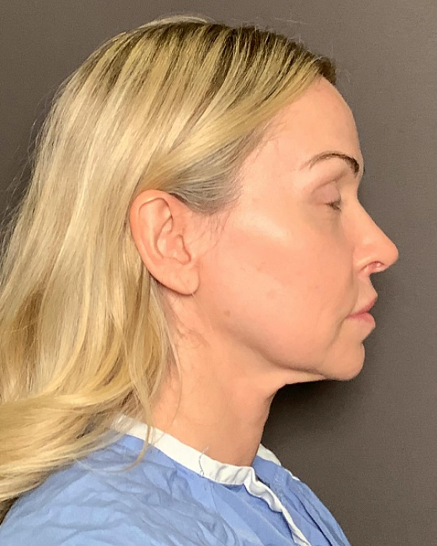 Nanolift Before & After Gallery - Patient 428237 - Image 3
