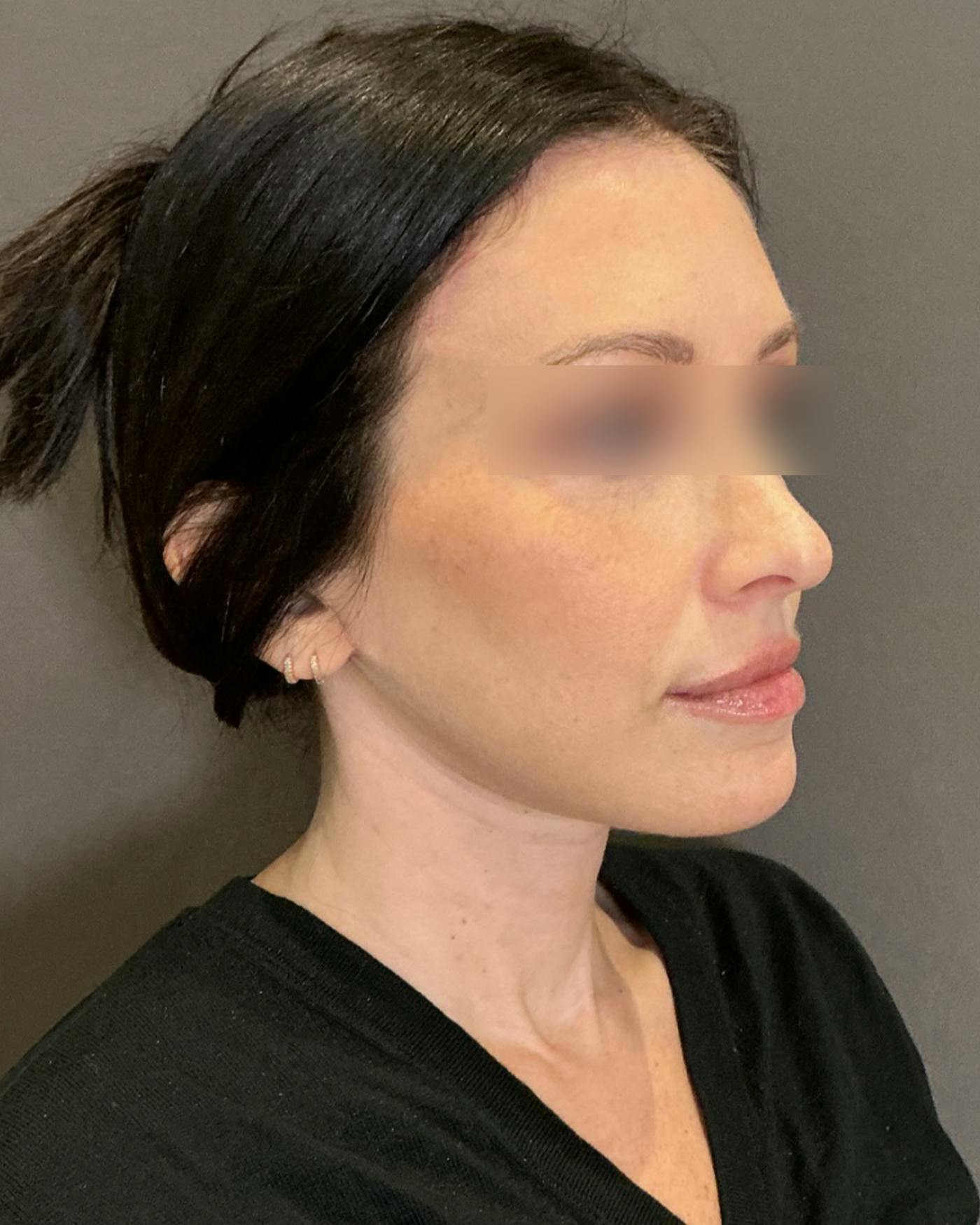 CO2 Full Face Before & After Gallery - Patient 922177 - Image 2