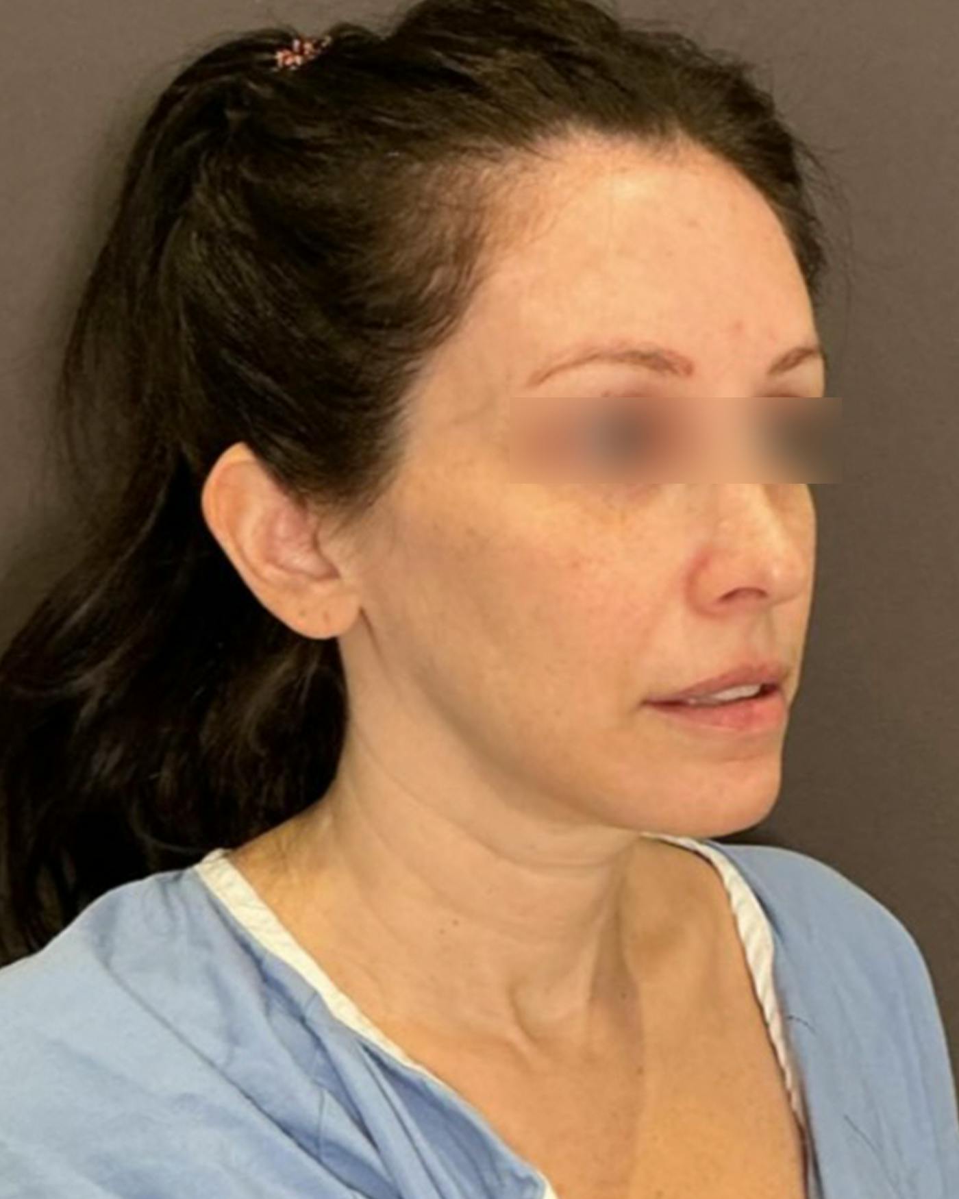 CO2 Full Face Before & After Gallery - Patient 922177 - Image 1