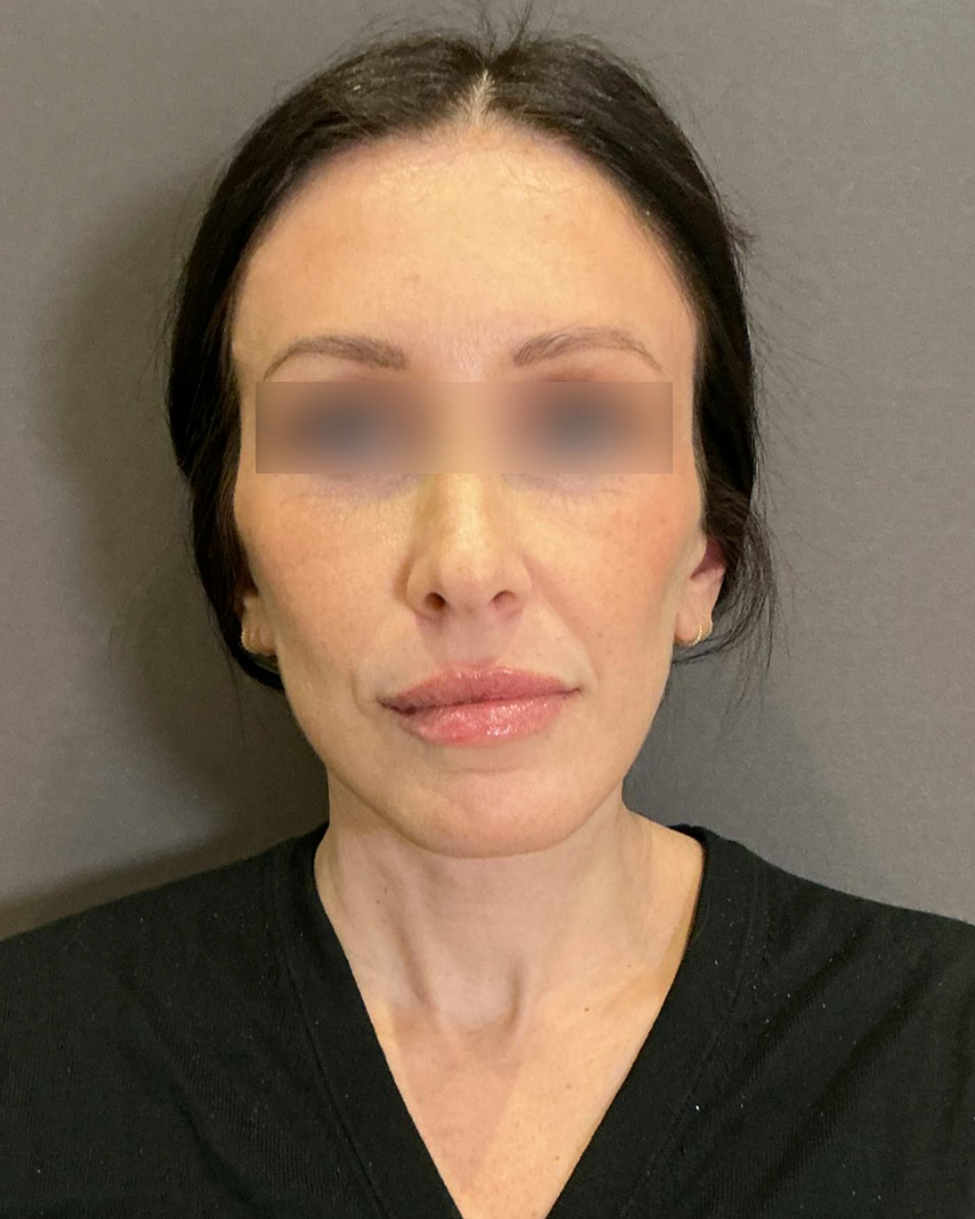 CO2 Full Face Before & After Gallery - Patient 922177 - Image 6
