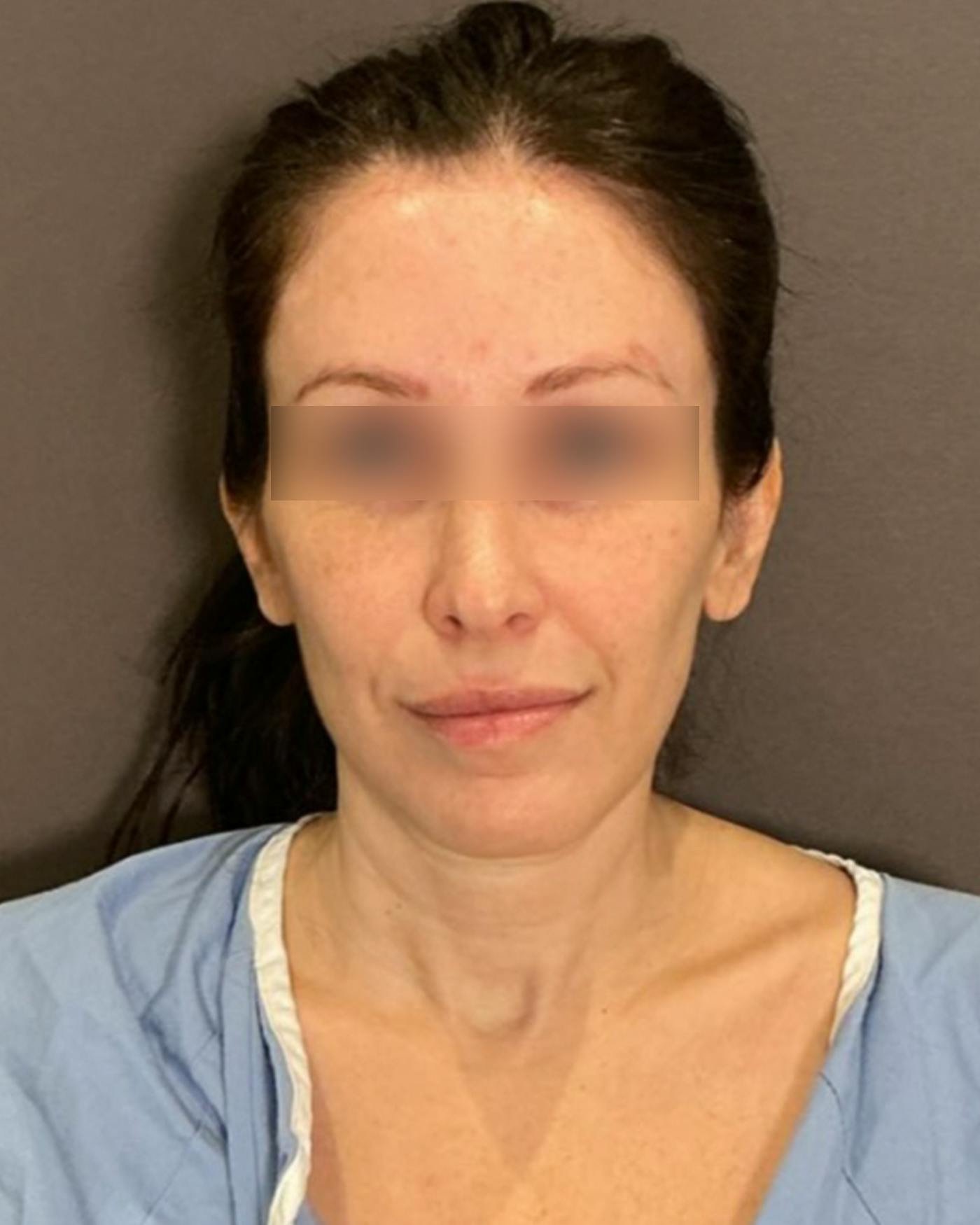 CO2 Full Face Before & After Gallery - Patient 922177 - Image 5