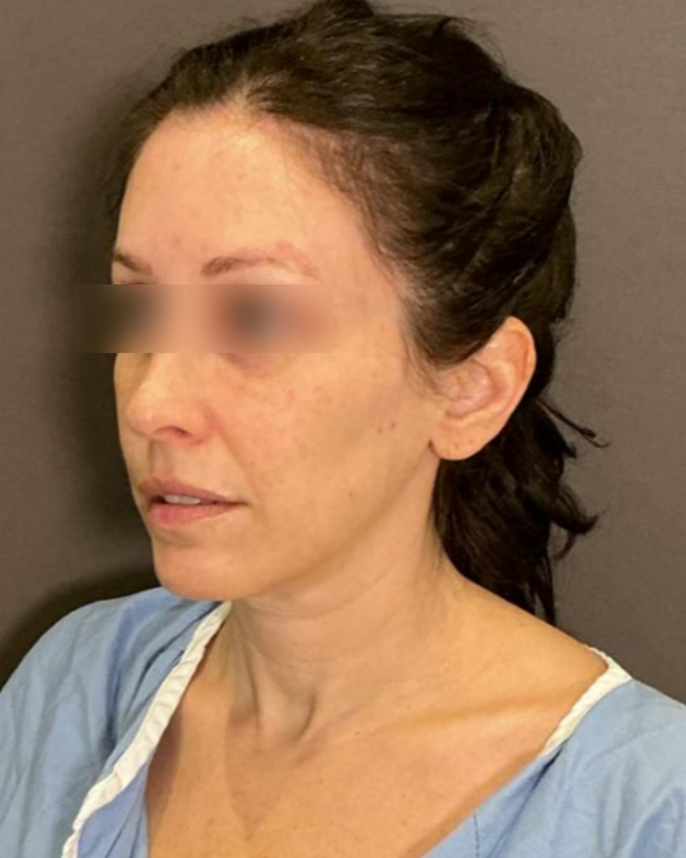 CO2 Full Face Before & After Gallery - Patient 922177 - Image 7