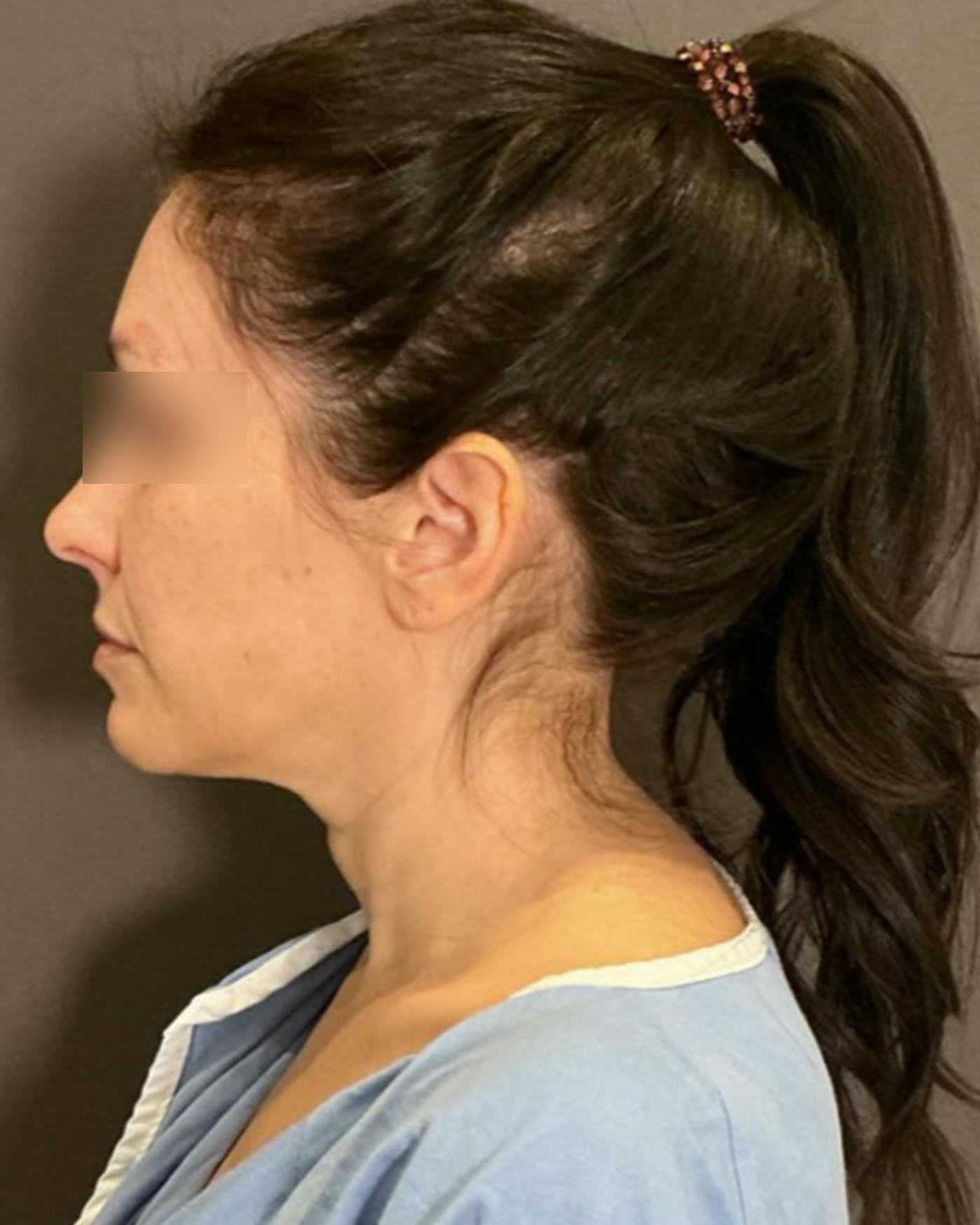 CO2 Full Face Before & After Gallery - Patient 922177 - Image 9