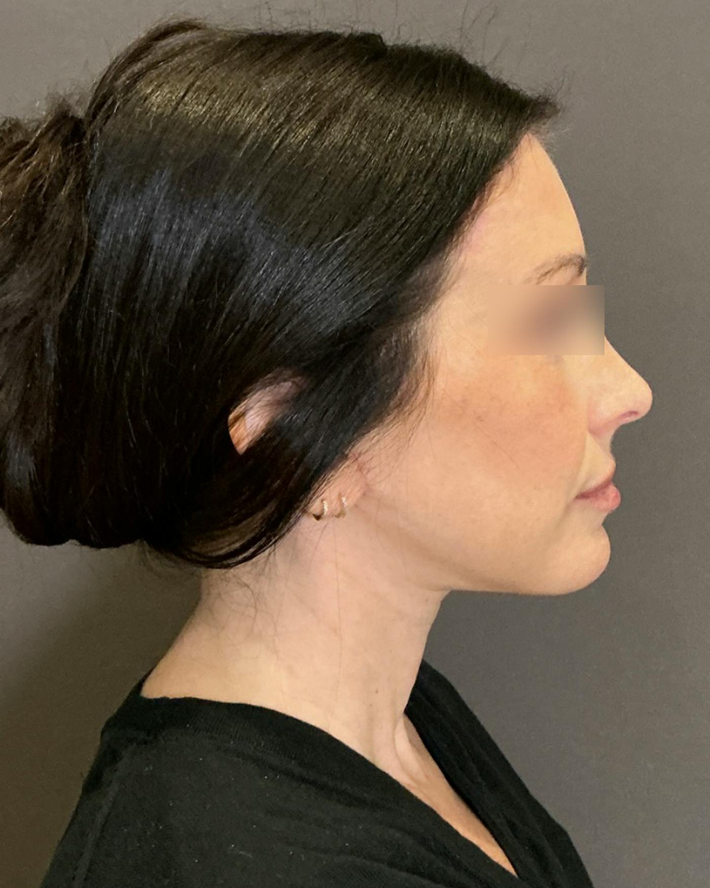 CO2 Full Face Before & After Gallery - Patient 922177 - Image 4