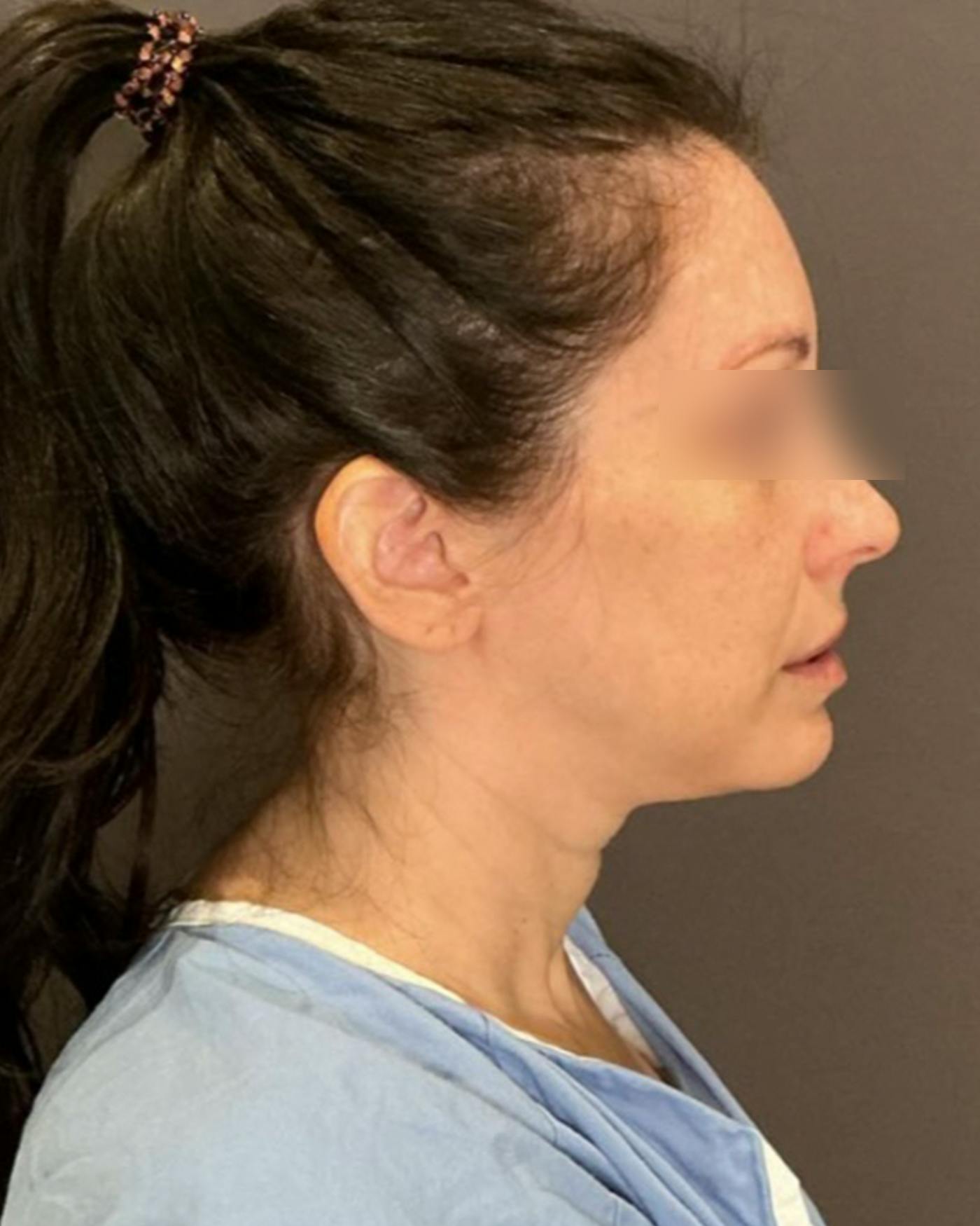 CO2 Full Face Before & After Gallery - Patient 922177 - Image 3