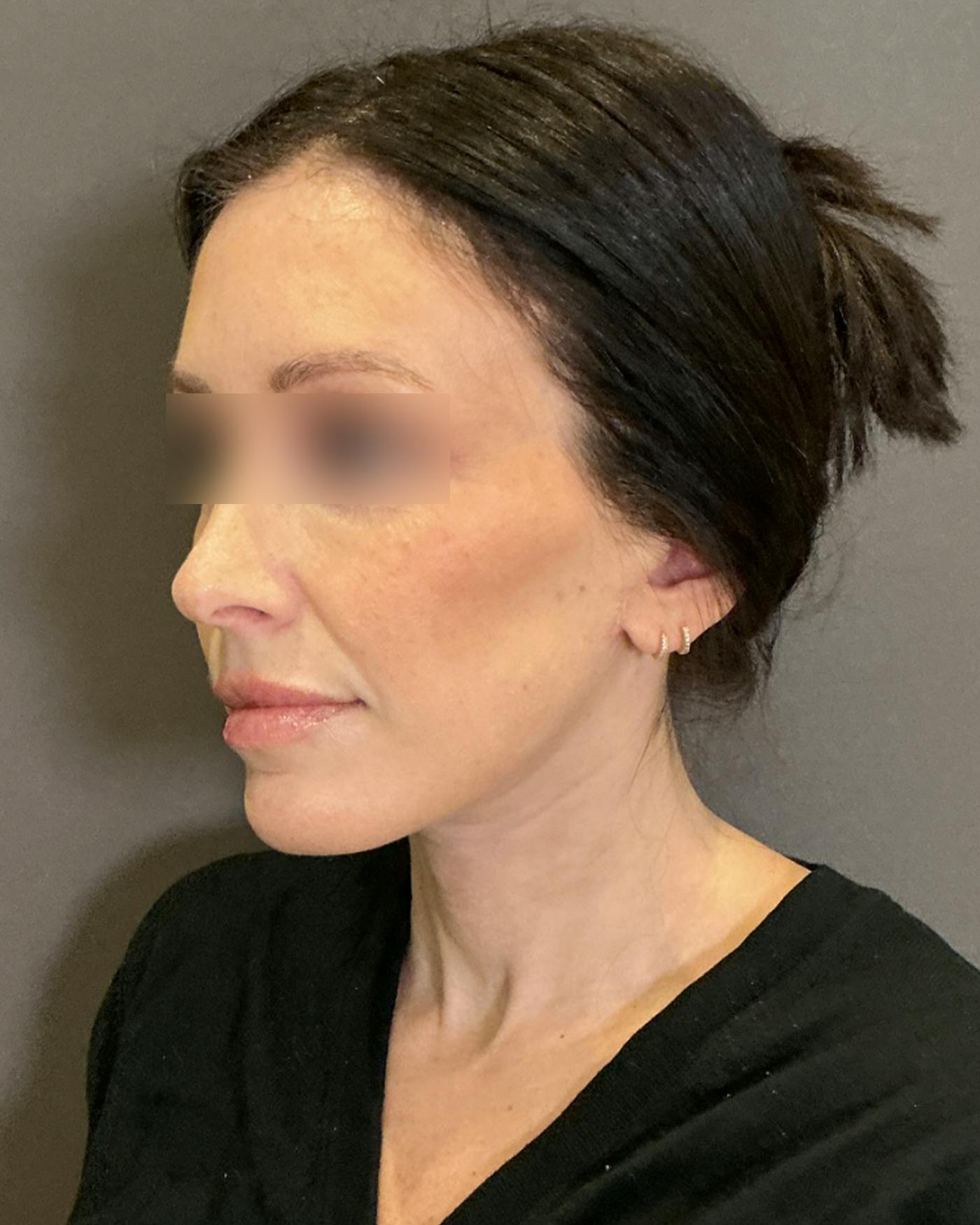 CO2 Full Face Before & After Gallery - Patient 922177 - Image 8