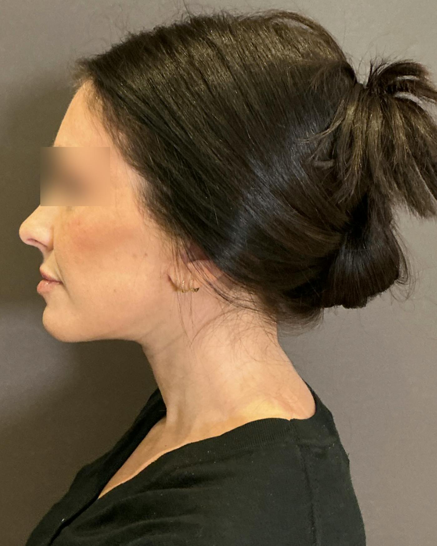 CO2 Full Face Before & After Gallery - Patient 922177 - Image 10
