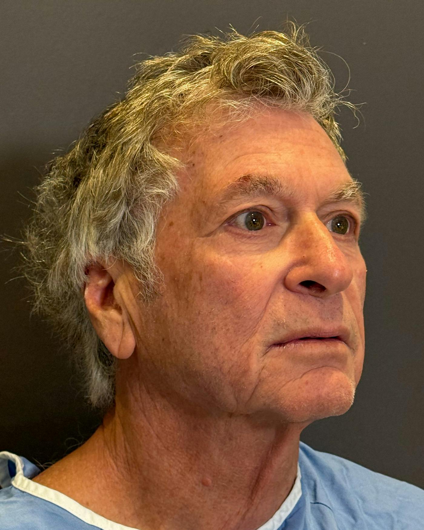 Facial Fat Transfer Before & After Gallery - Patient 244414 - Image 3