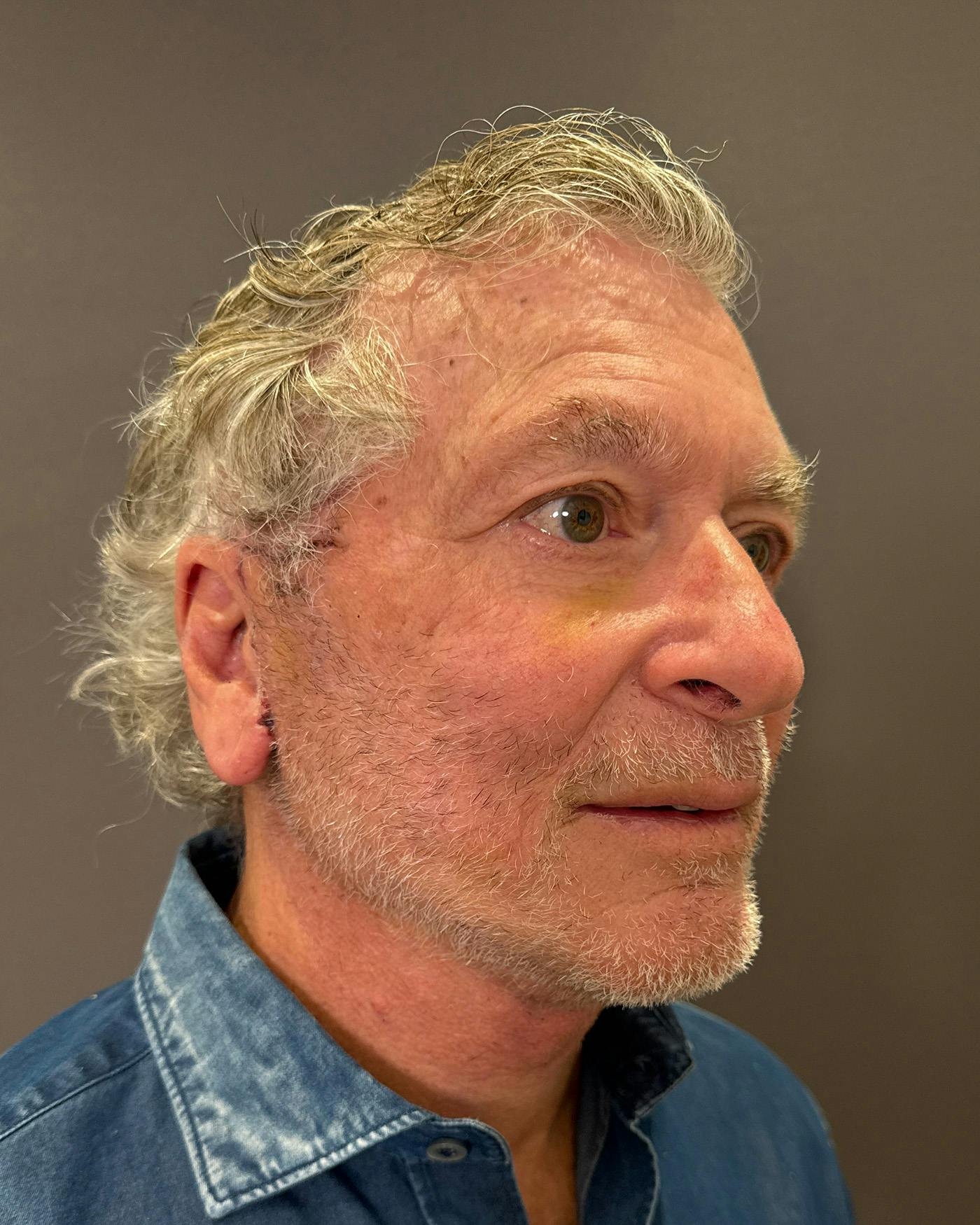 Facial Fat Transfer Before & After Gallery - Patient 244414 - Image 4