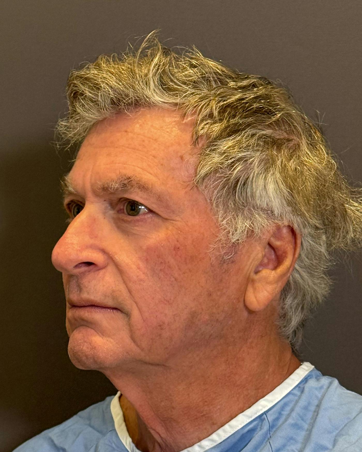 Facial Fat Transfer Before & After Gallery - Patient 244414 - Image 5