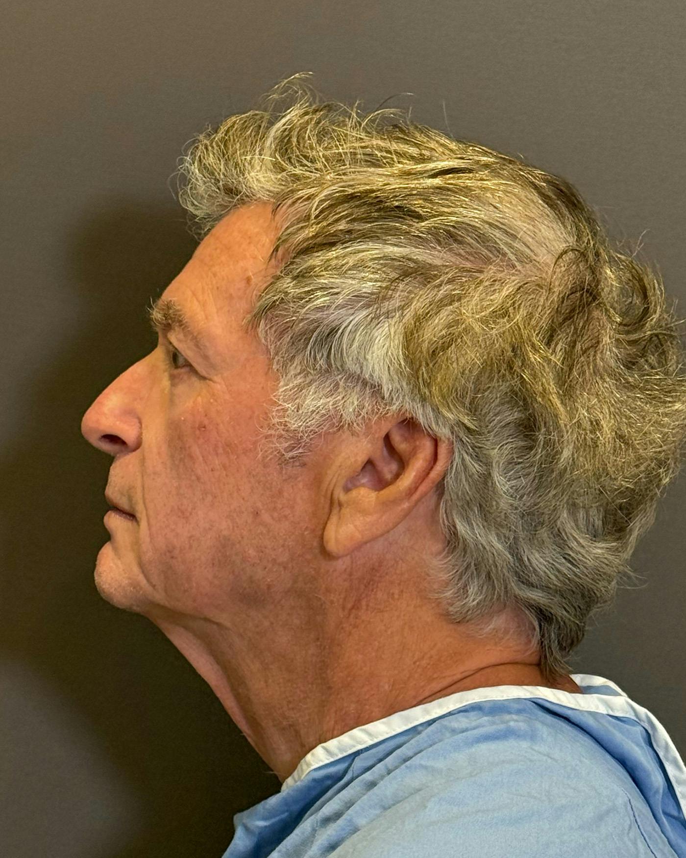 Facial Fat Transfer Before & After Gallery - Patient 244414 - Image 7