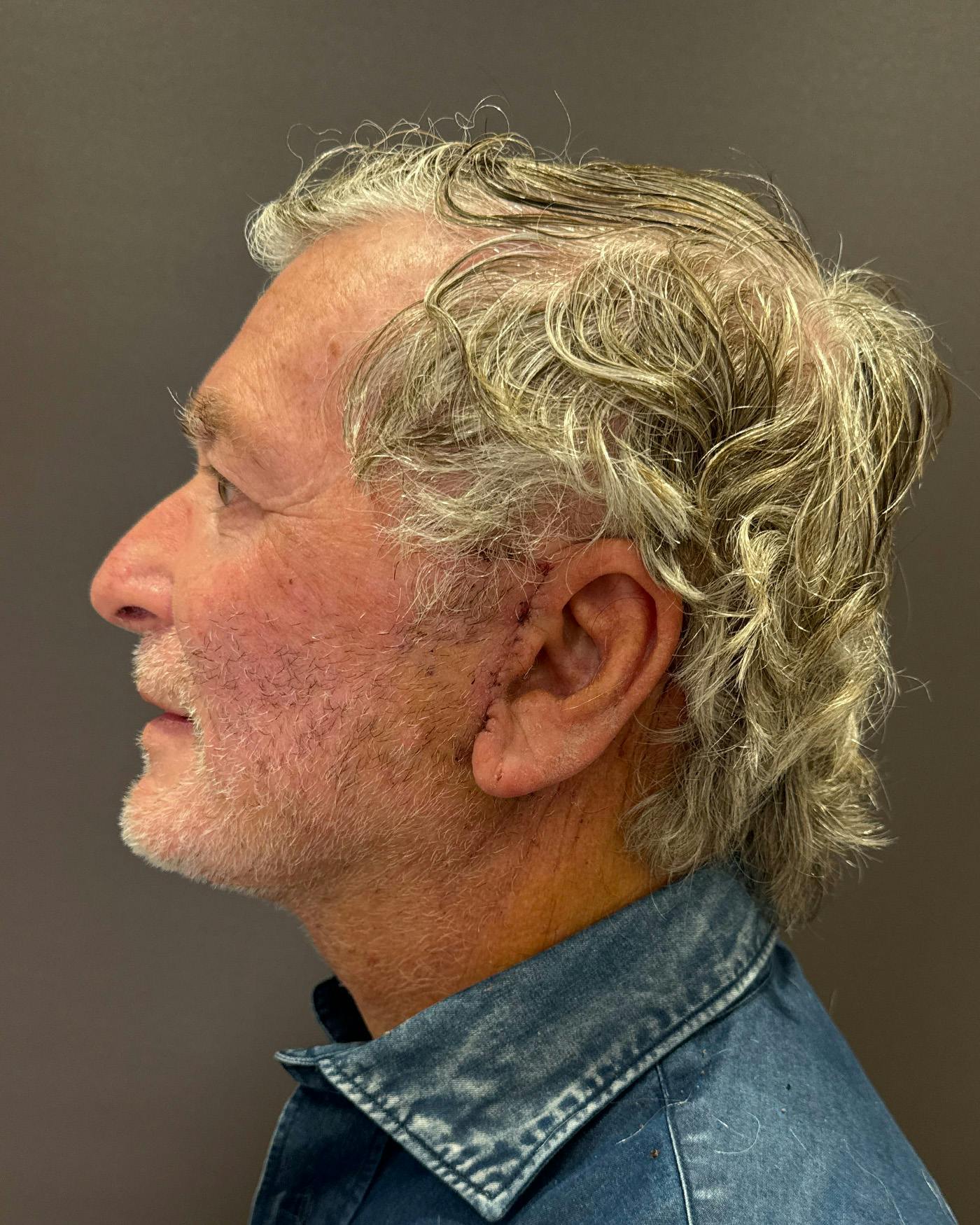 Facial Fat Transfer Before & After Gallery - Patient 244414 - Image 8